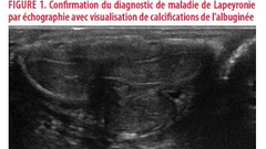 Pathologies urologiques induites par l’infection COVID-19, une revue de la littérature à partir d’une observation de Lapeyronie