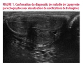 Pathologies urologiques induites par l’infection COVID-19, une revue de la littérature à partir d’une observation de Lapeyronie