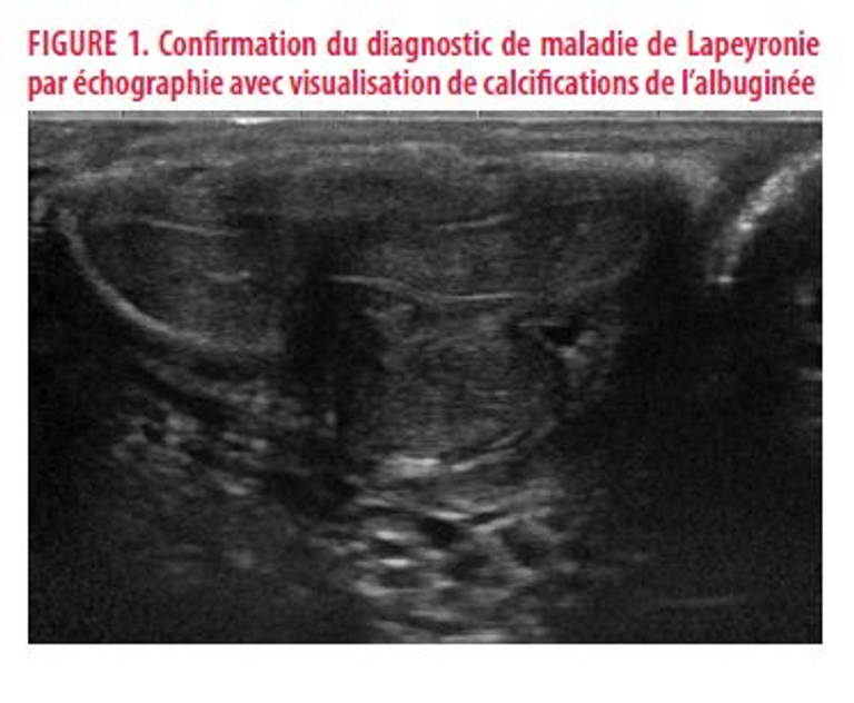 Pathologies urologiques induites par l’infection COVID-19, une revue de la littérature à partir d’une observation de Lapeyronie