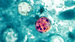 More Than 300 Confirmed Cases of Foodborne Parasitic Illness in Michigan as Outbreak Continues to Grow