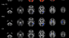 Brain imaging and neuropsychological assessment of individuals recovered from a mild to moderate SARS-CoV-2 infection