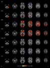 Brain imaging and neuropsychological assessment of individuals recovered from a mild to moderate SARS-CoV-2 infection
