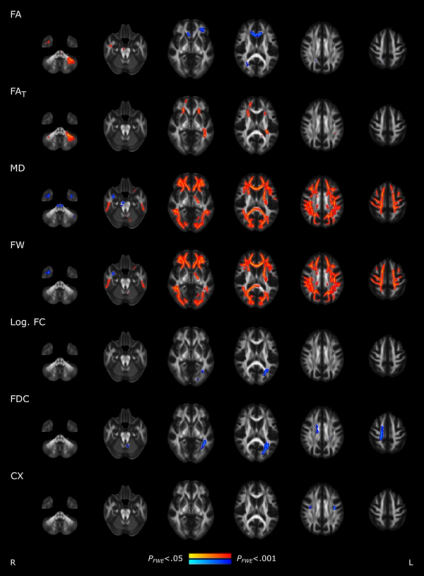 Brain imaging and neuropsychological assessment of individuals recovered from a mild to moderate SARS-CoV-2 infection