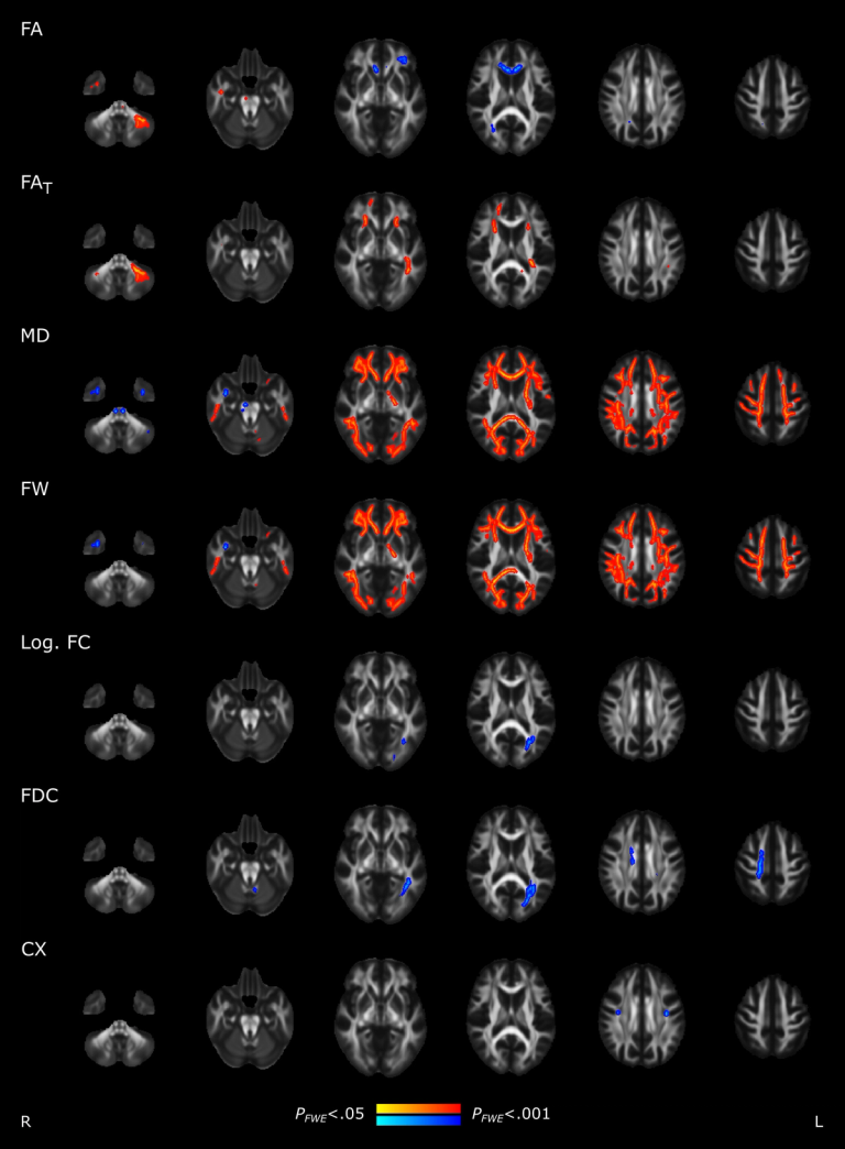 Brain imaging and neuropsychological assessment of individuals recovered from a mild to moderate SARS-CoV-2 infection
