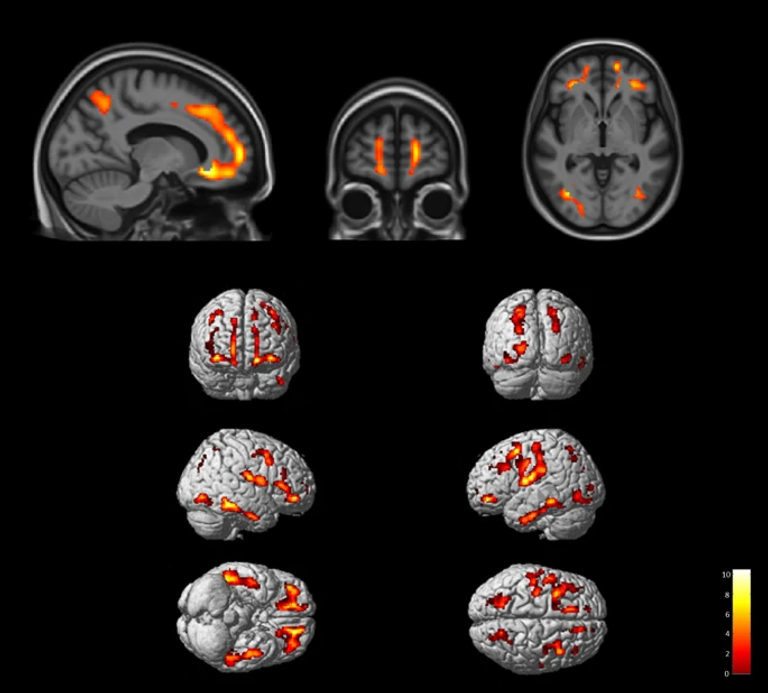 Mapping brain changes in post-COVID-19 cognitive decline via FDG PET hypometabolism and EEG slowing