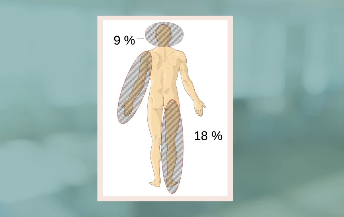 Brännskadans yta kan uppskattas med 9%-regeln.