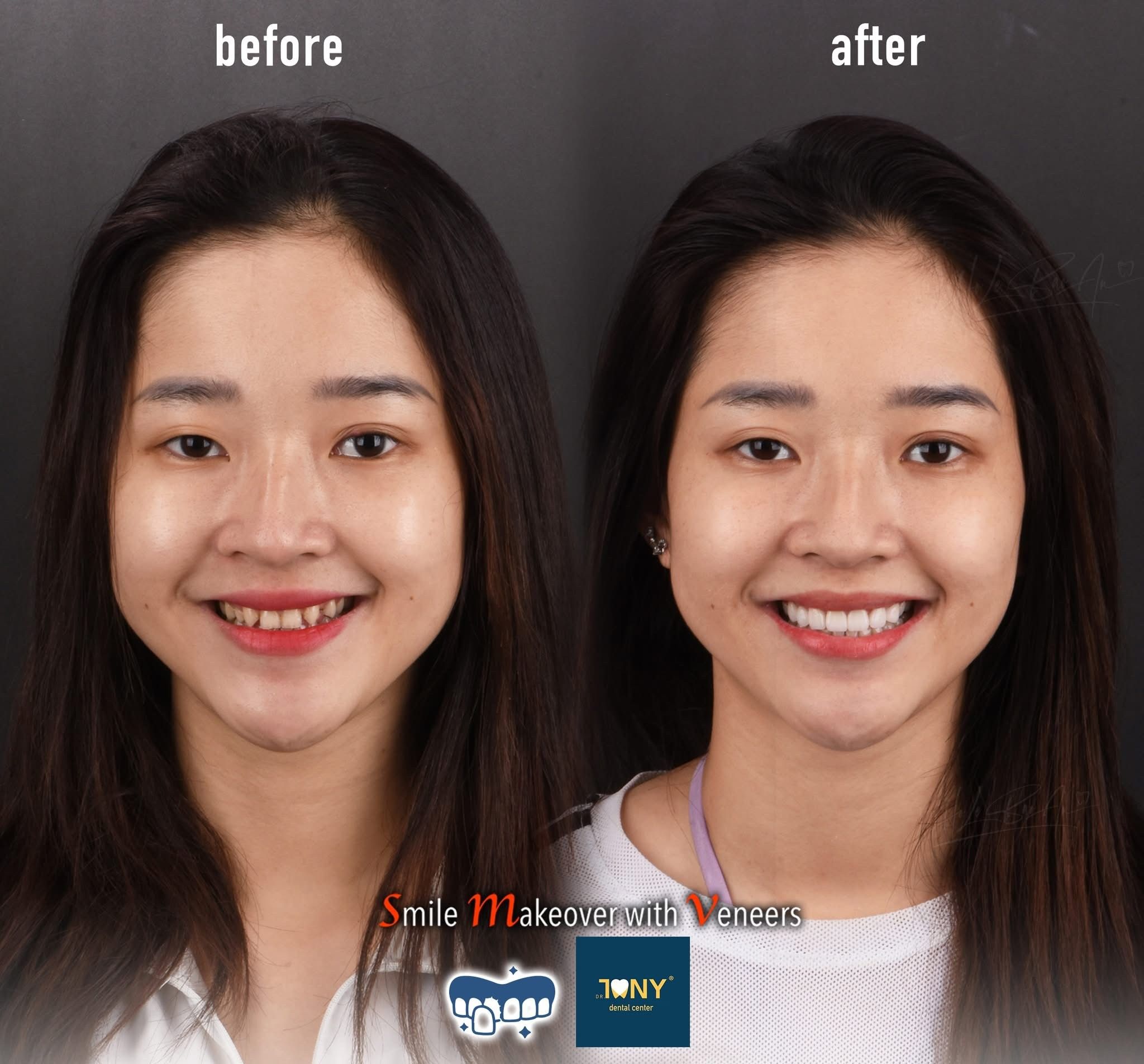 Chân dung trước và sau khi làm mặt dán sứ Veneer tại Dr Tony Dental
