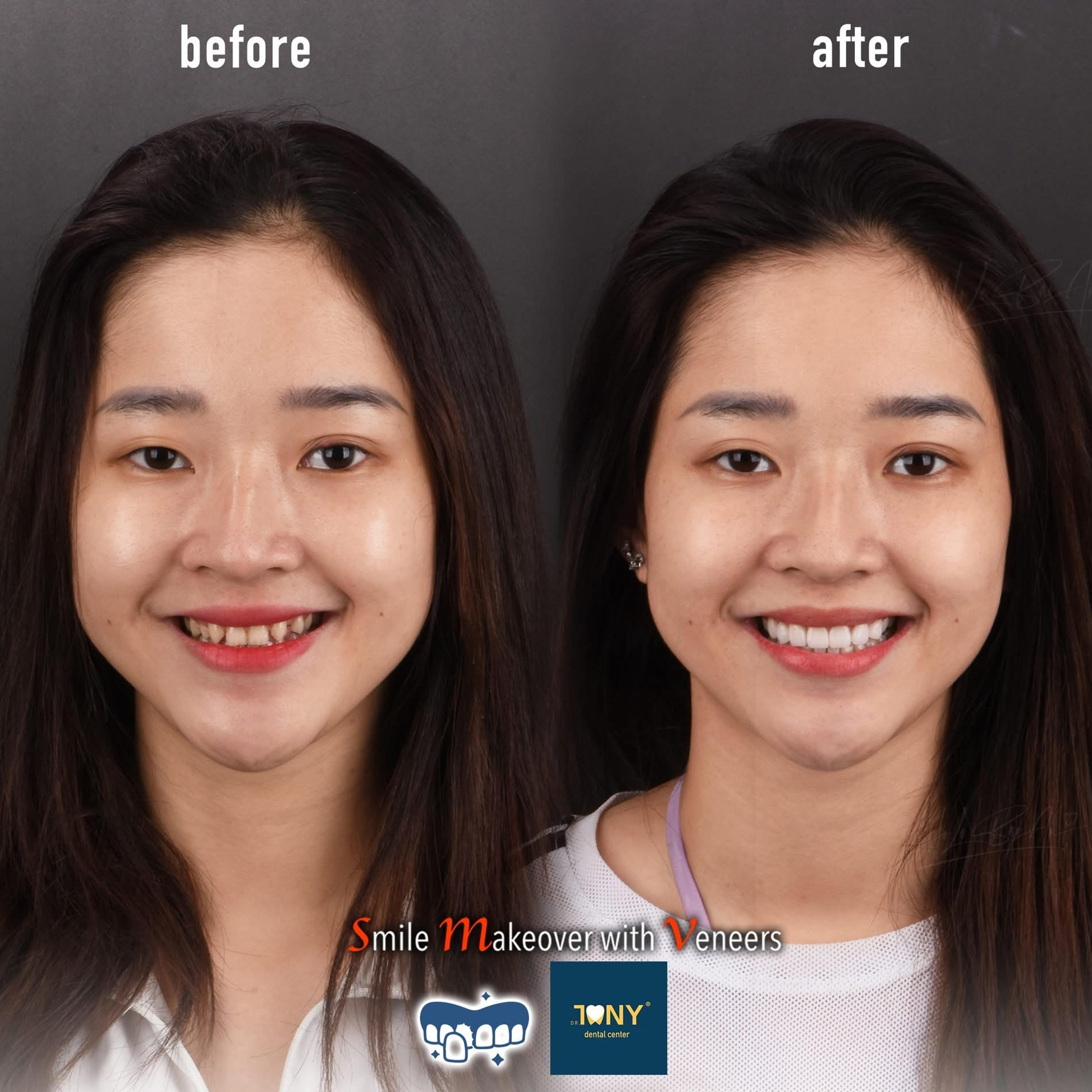 Chân dung trước và sau khi làm mặt dán sứ Veneer tại Dr Tony Dental