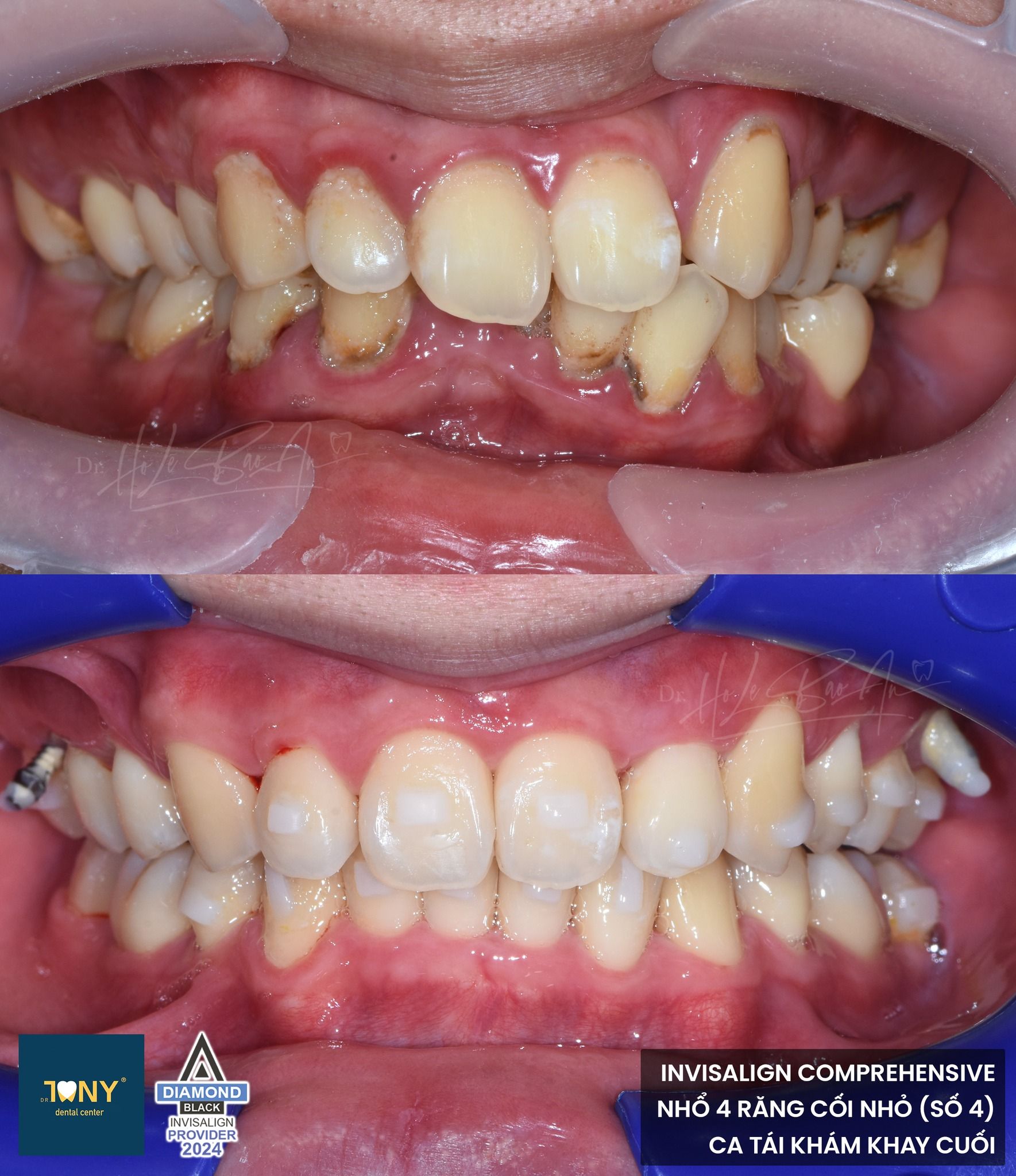 Ca Invisalign Comprehensive có nhổ 4 răng cối nhỏ (răng số 4) — ảnh ban đầu và ở lần tái khám khay cuối
