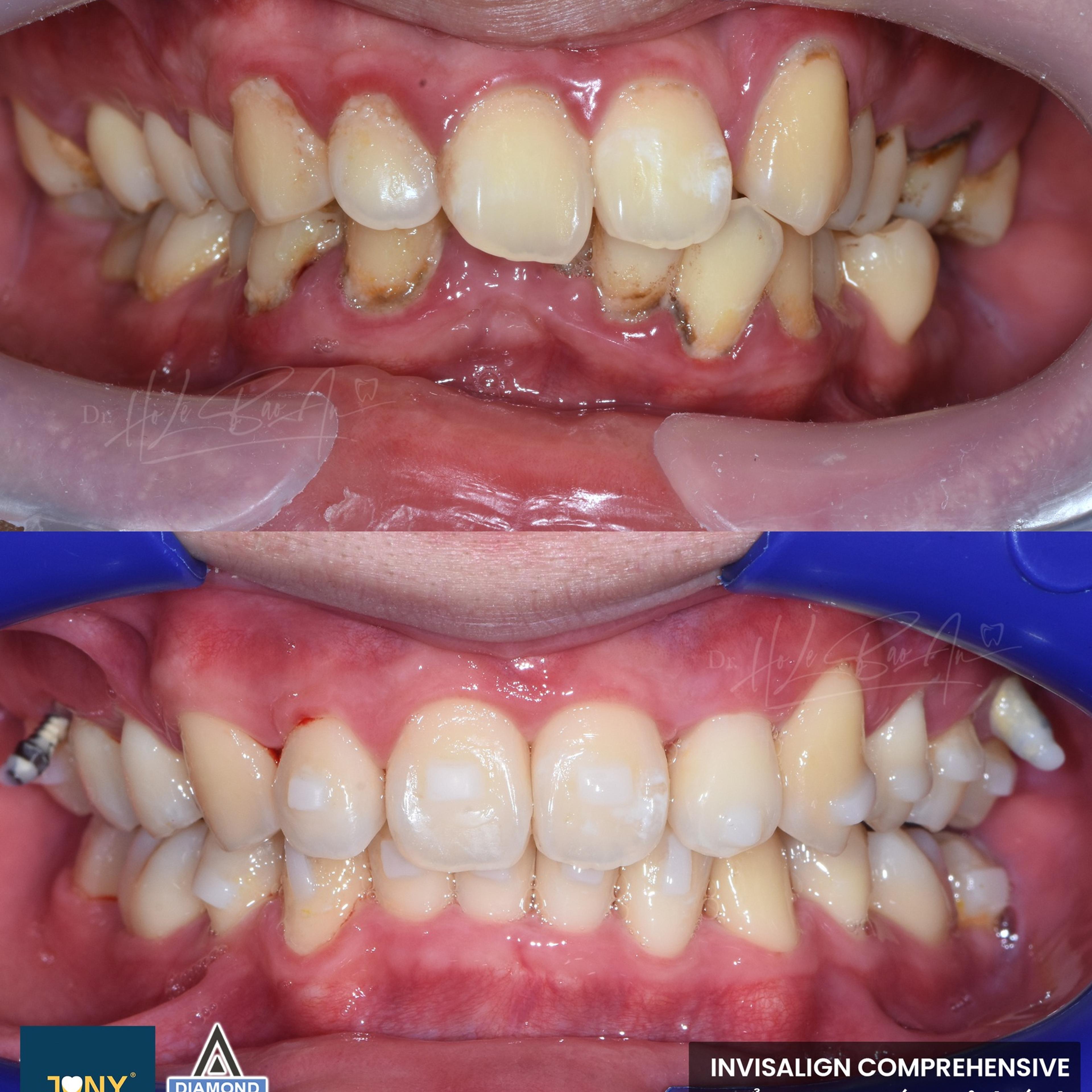 Ca Invisalign Comprehensive có nhổ 4 răng cối nhỏ (răng số 4) — ảnh ban đầu và ở lần tái khám khay cuối