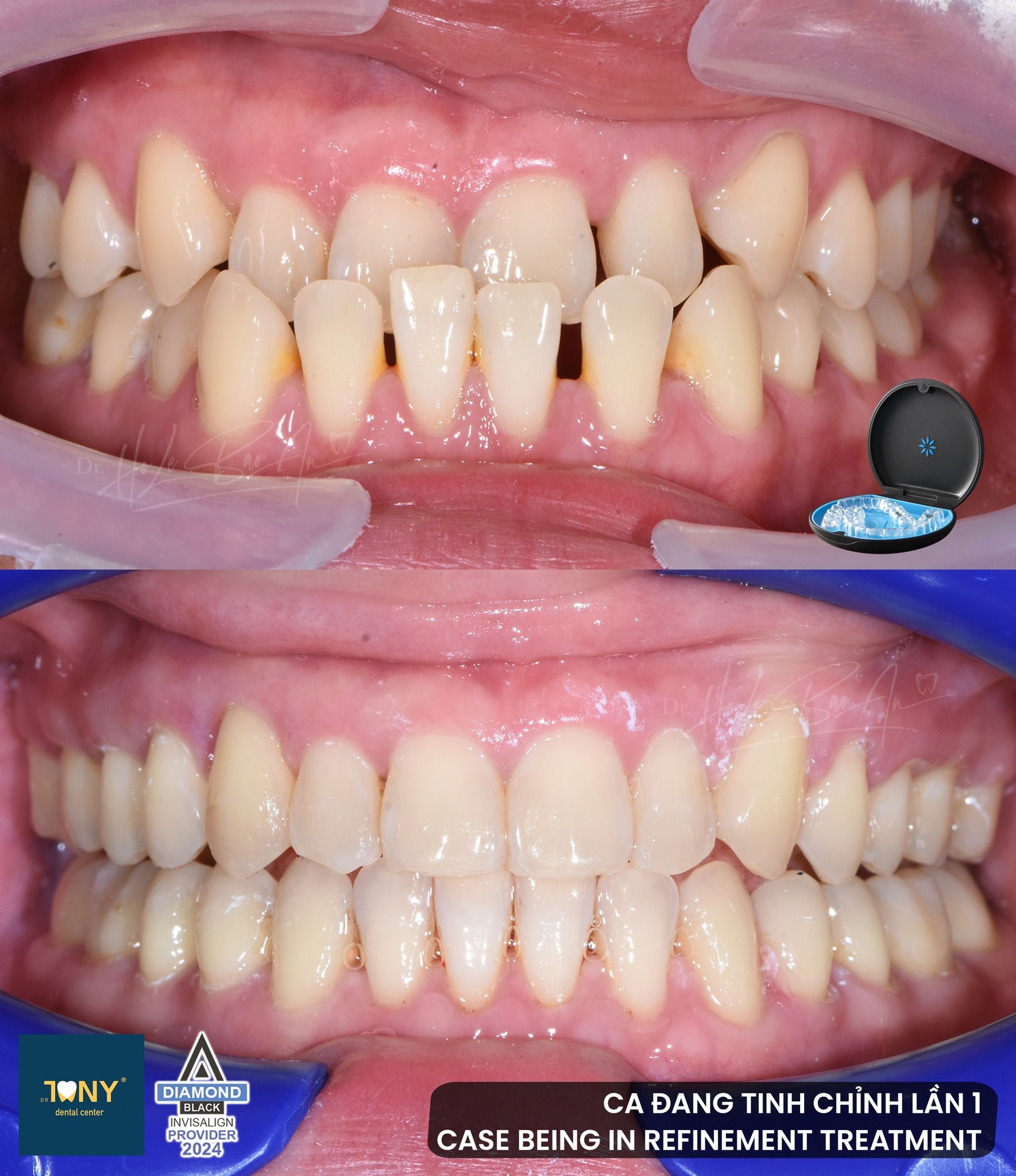 Ca Invisalign đang tinh chỉnh lần 1: ảnh trong miệng lúc ban đầu và ở thời điểm tinh chỉnh