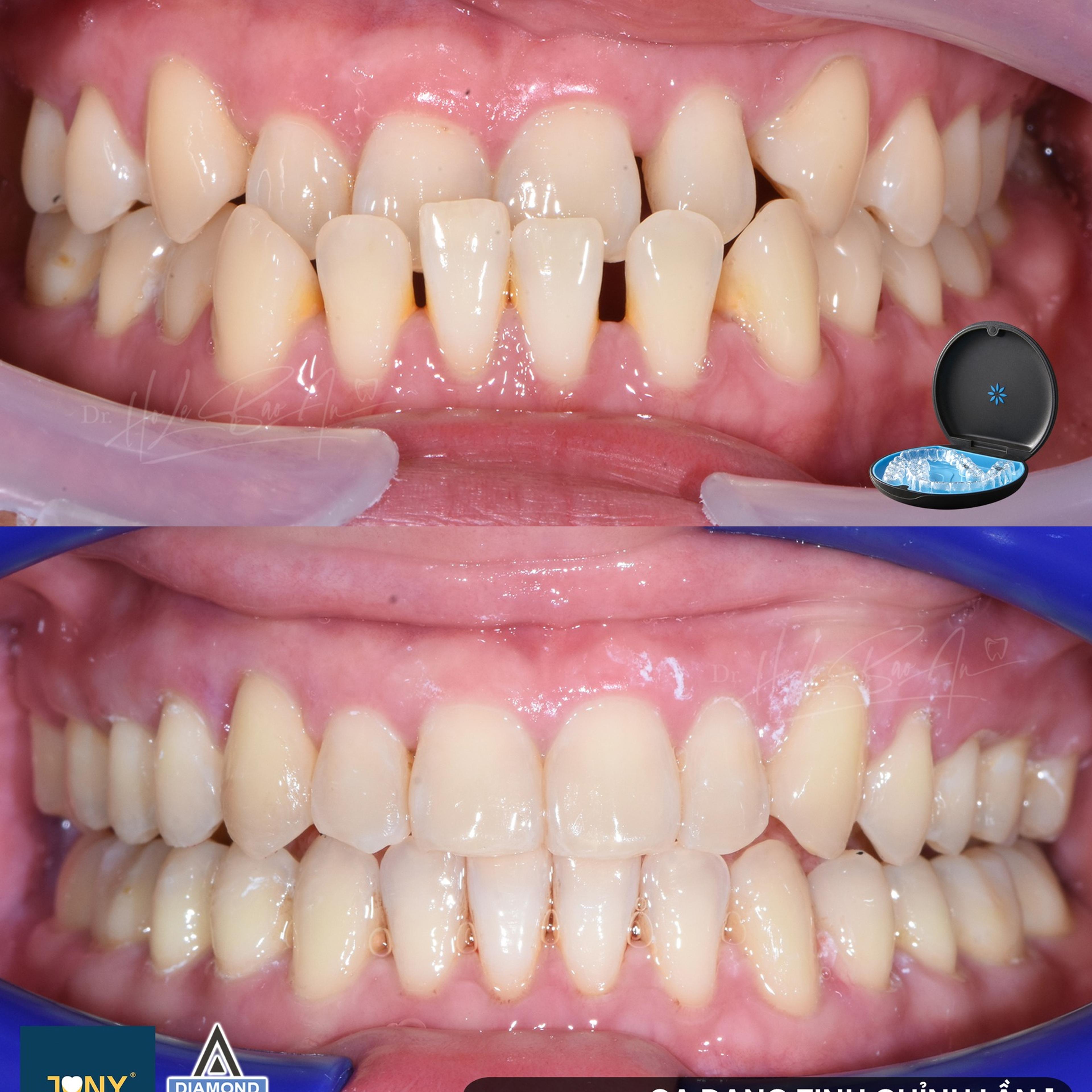 Ca Invisalign đang tinh chỉnh lần 1: ảnh trong miệng lúc ban đầu và ở thời điểm tinh chỉnh