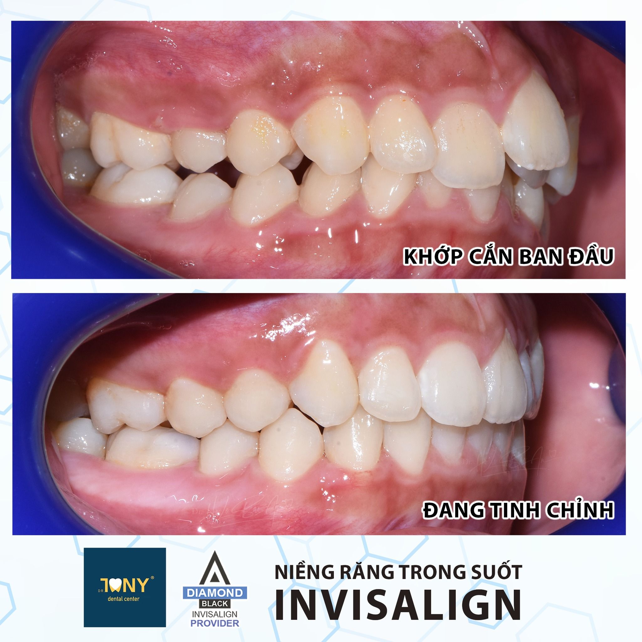 Khớp cắn nhìn từ bên, ban đầu và ở giai đoạn đang tinh chỉnh của một ca niềng Invisalign