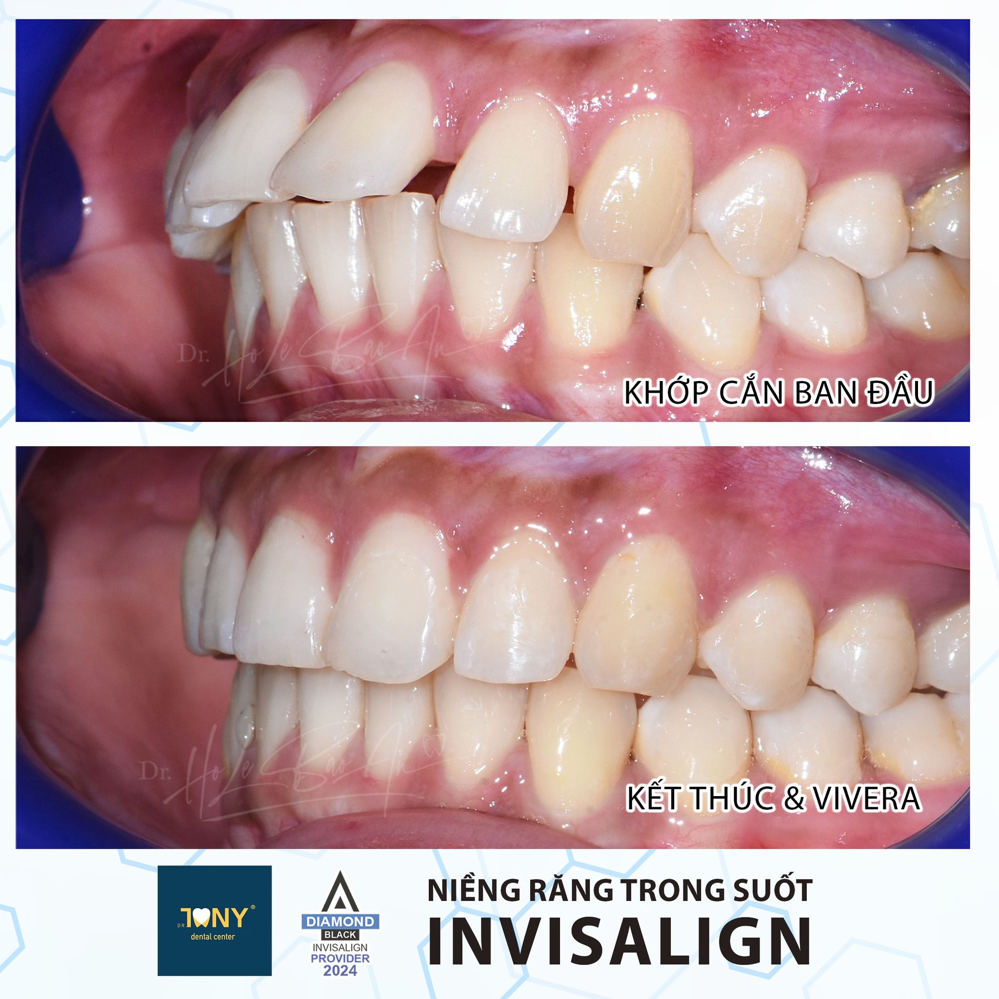 Khớp cắn nhìn từ bên, ban đầu và khi kết thúc điều trị Invisalign, chuyển sang hàm duy trì Vivera