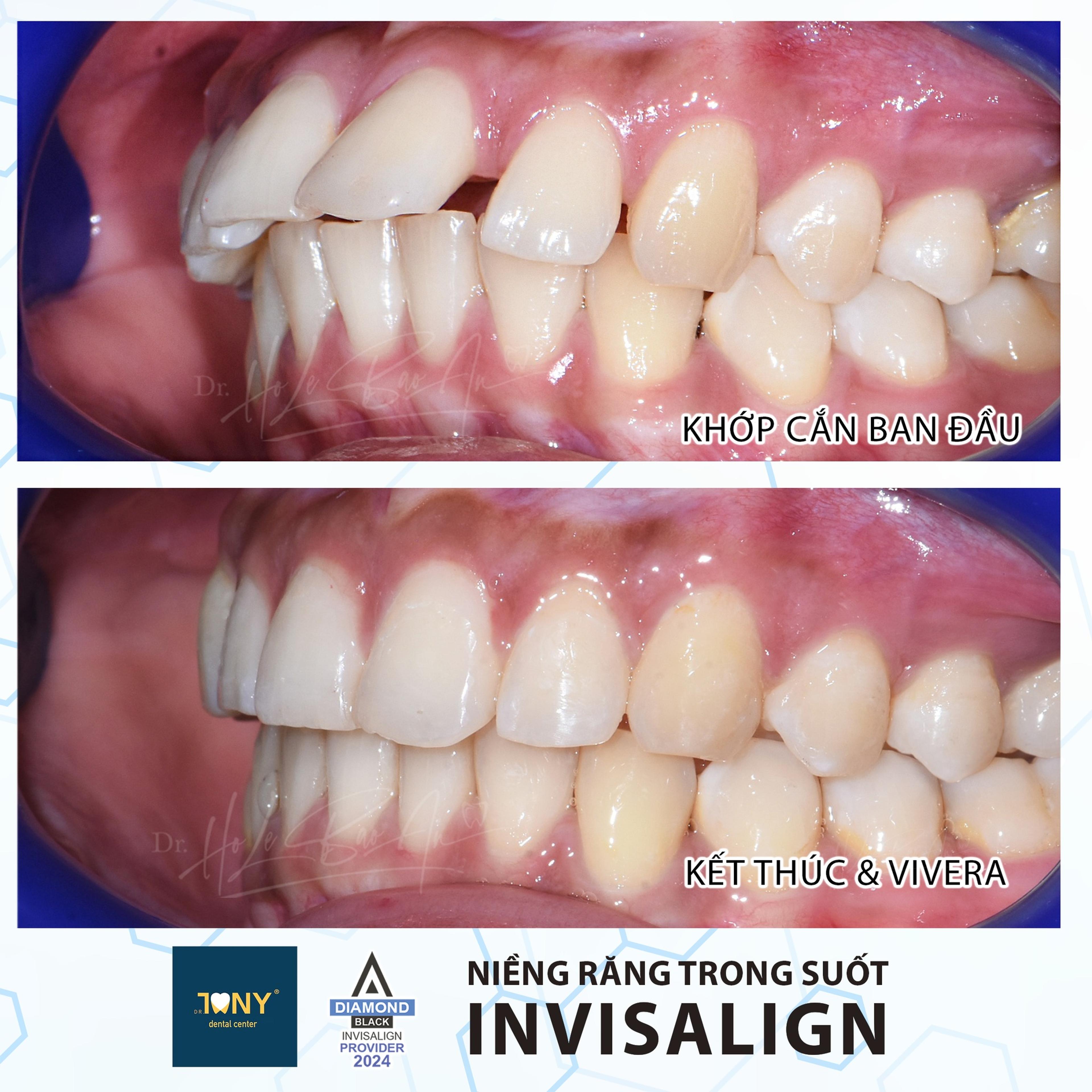 Khớp cắn nhìn từ bên, ban đầu và khi kết thúc điều trị Invisalign, chuyển sang hàm duy trì Vivera