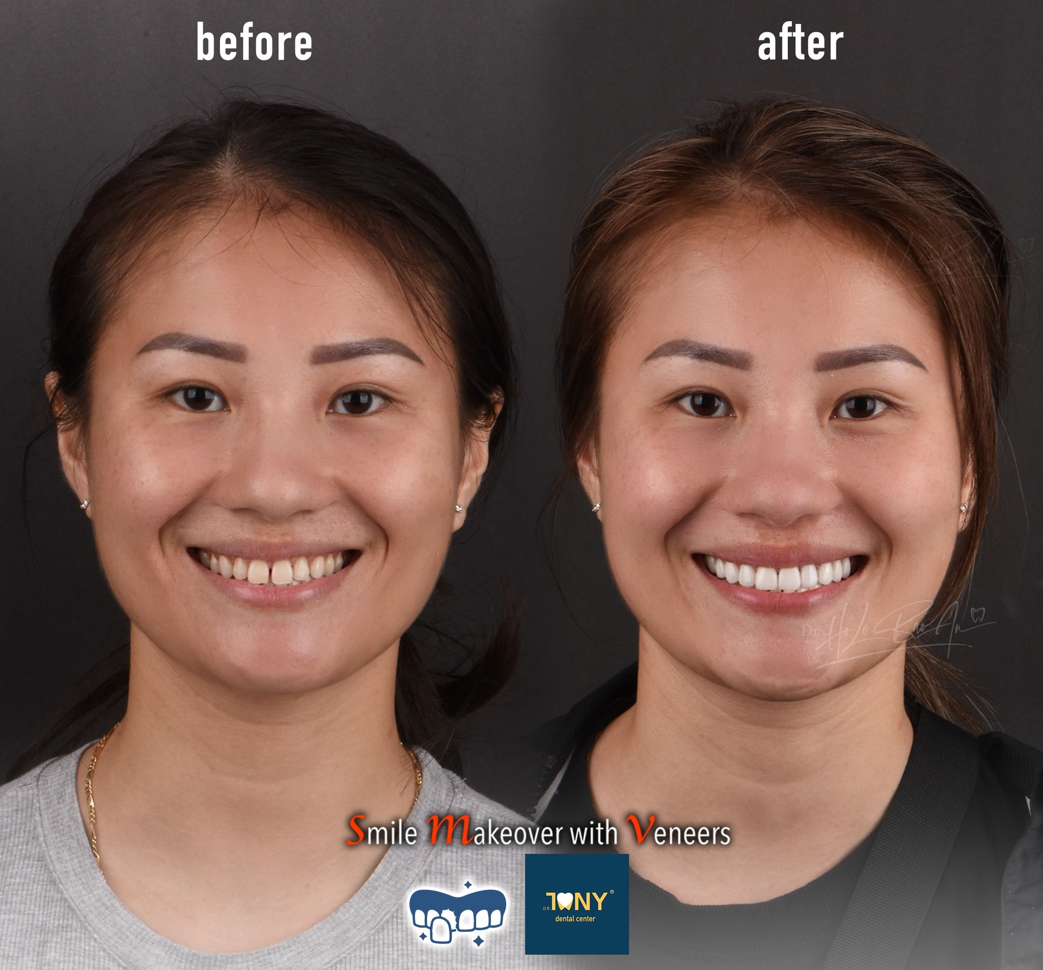 Full-face smile before and after porcelain veneers: short, discoloured incisors, longer and even afterwards