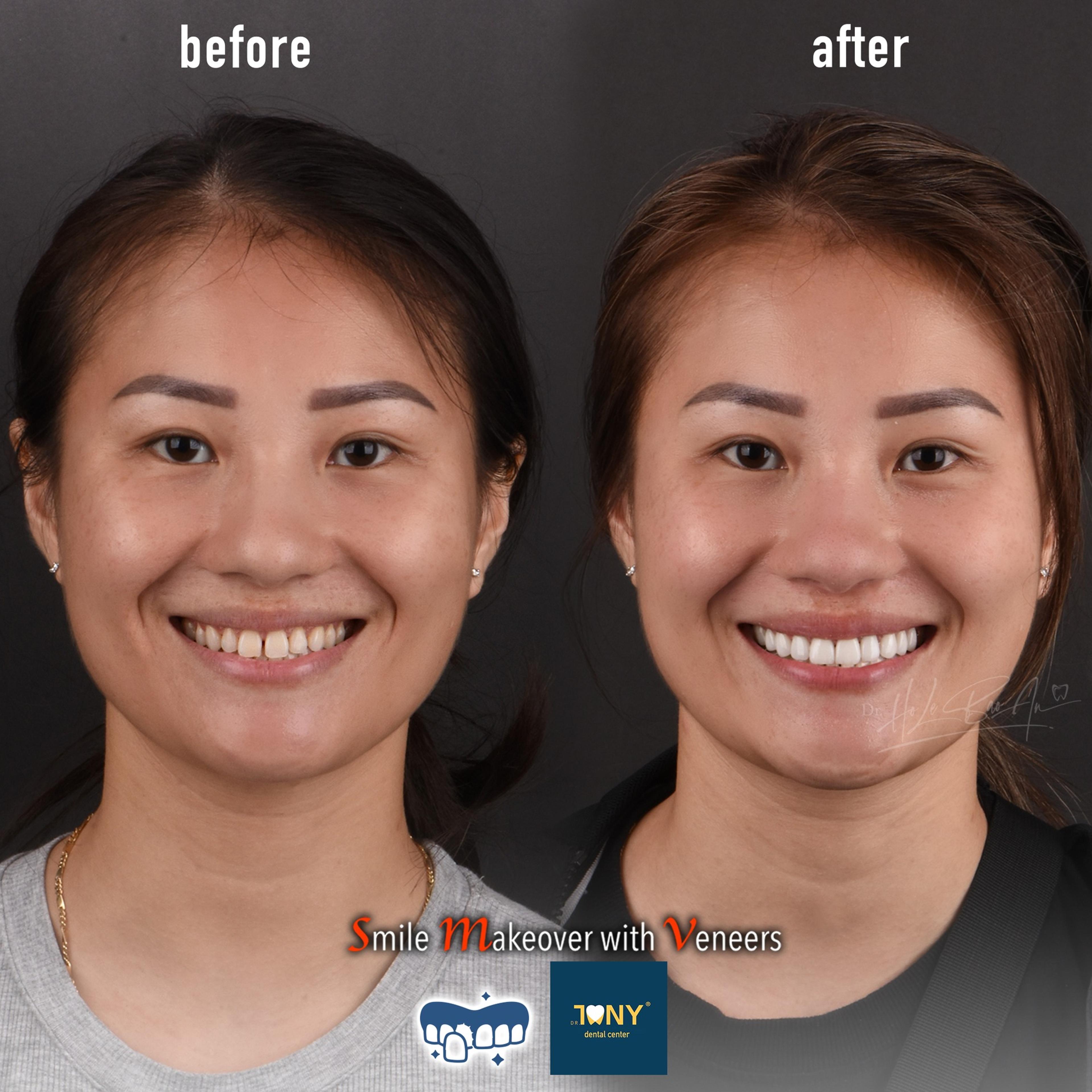 Full-face smile before and after porcelain veneers: short, discoloured incisors, longer and even afterwards