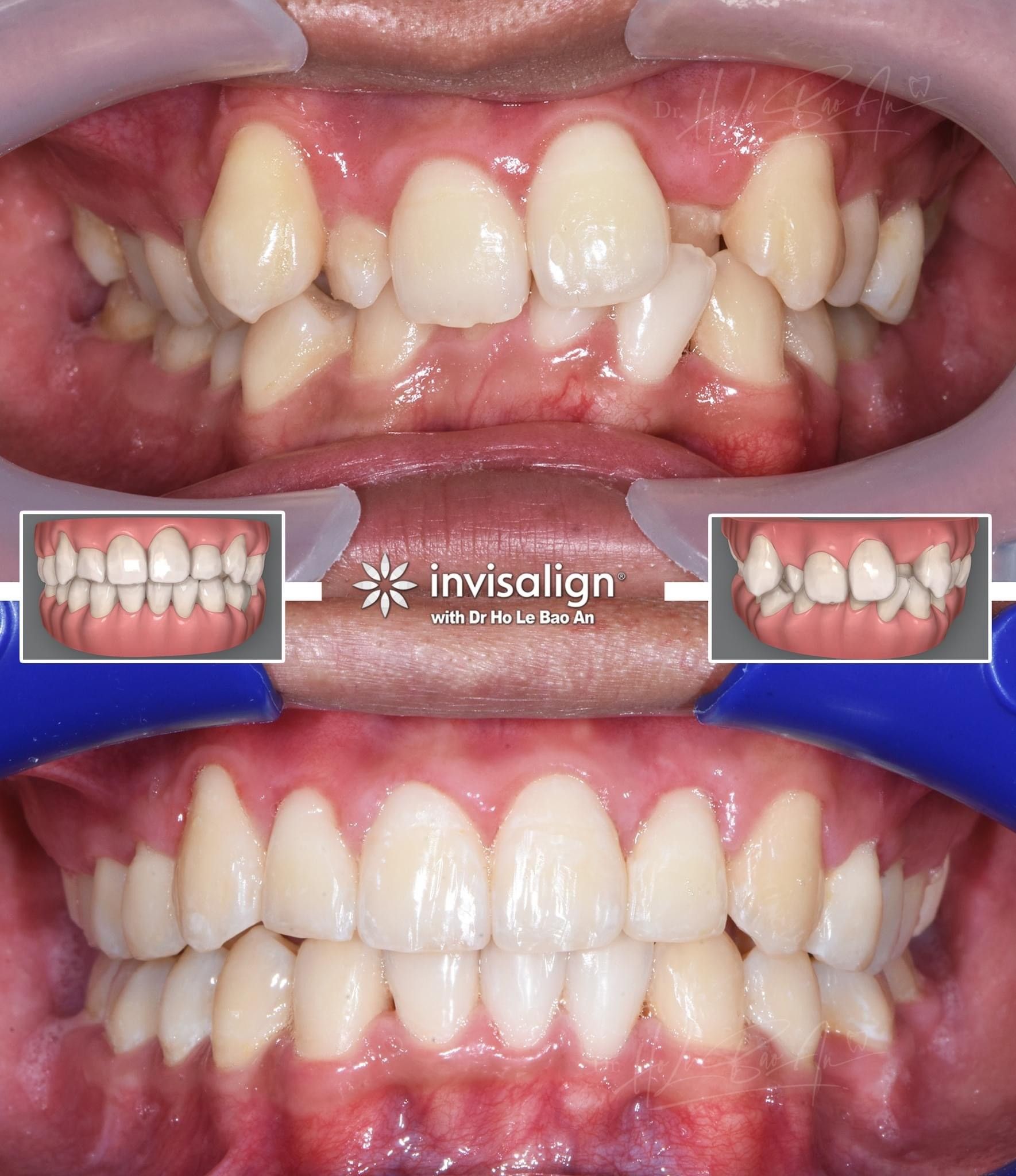 Ảnh trong miệng trước và sau, kèm mô phỏng ClinCheck 3D: răng chen chúc nặng, răng cửa bên bị kẹt