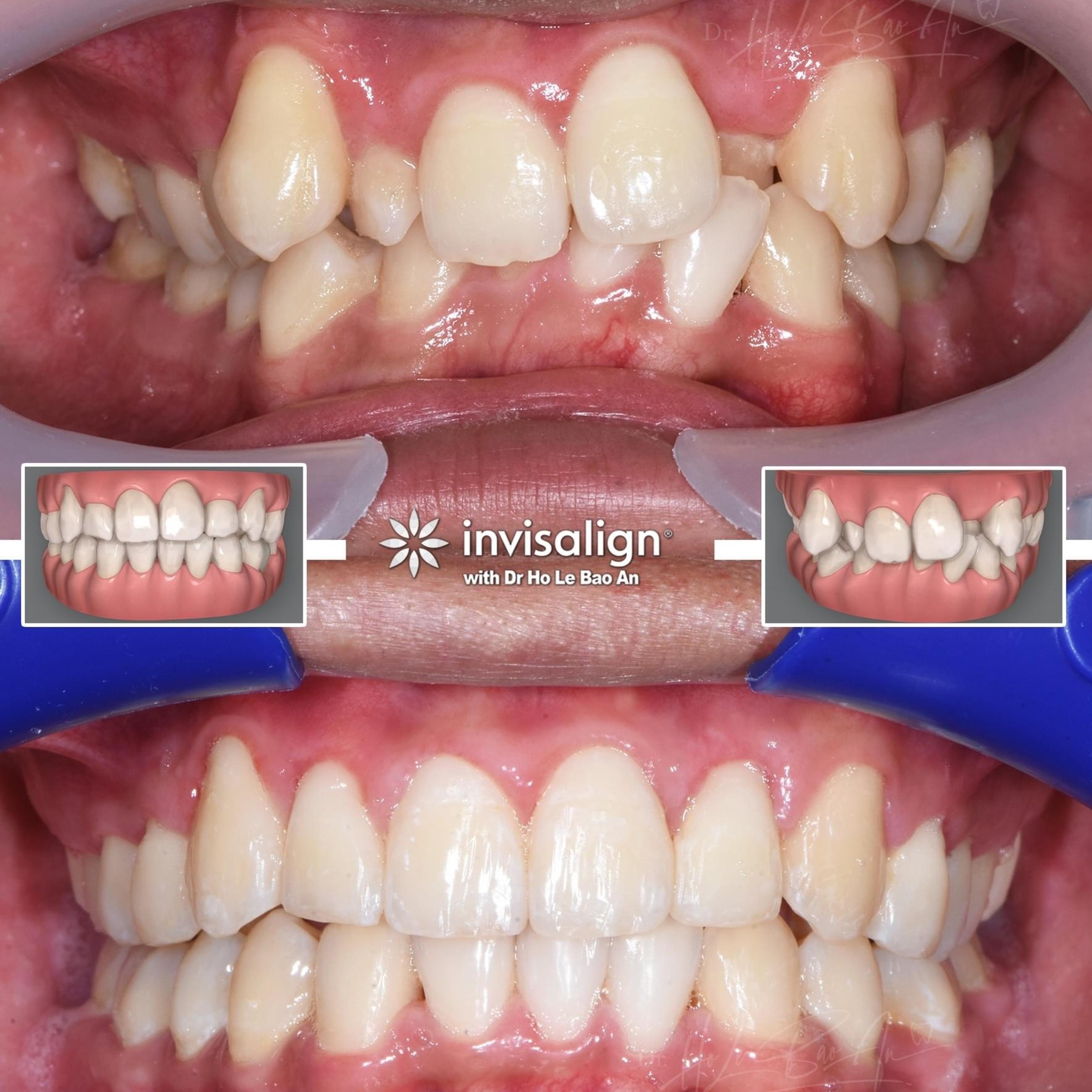 Ảnh trong miệng trước và sau, kèm mô phỏng ClinCheck 3D: răng chen chúc nặng, răng cửa bên bị kẹt