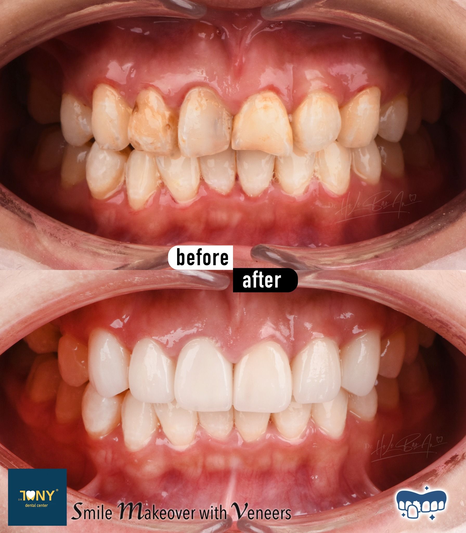 Intraoral views of both arches before and after veneers: patchy discolouration, even in colour and shape afterwards