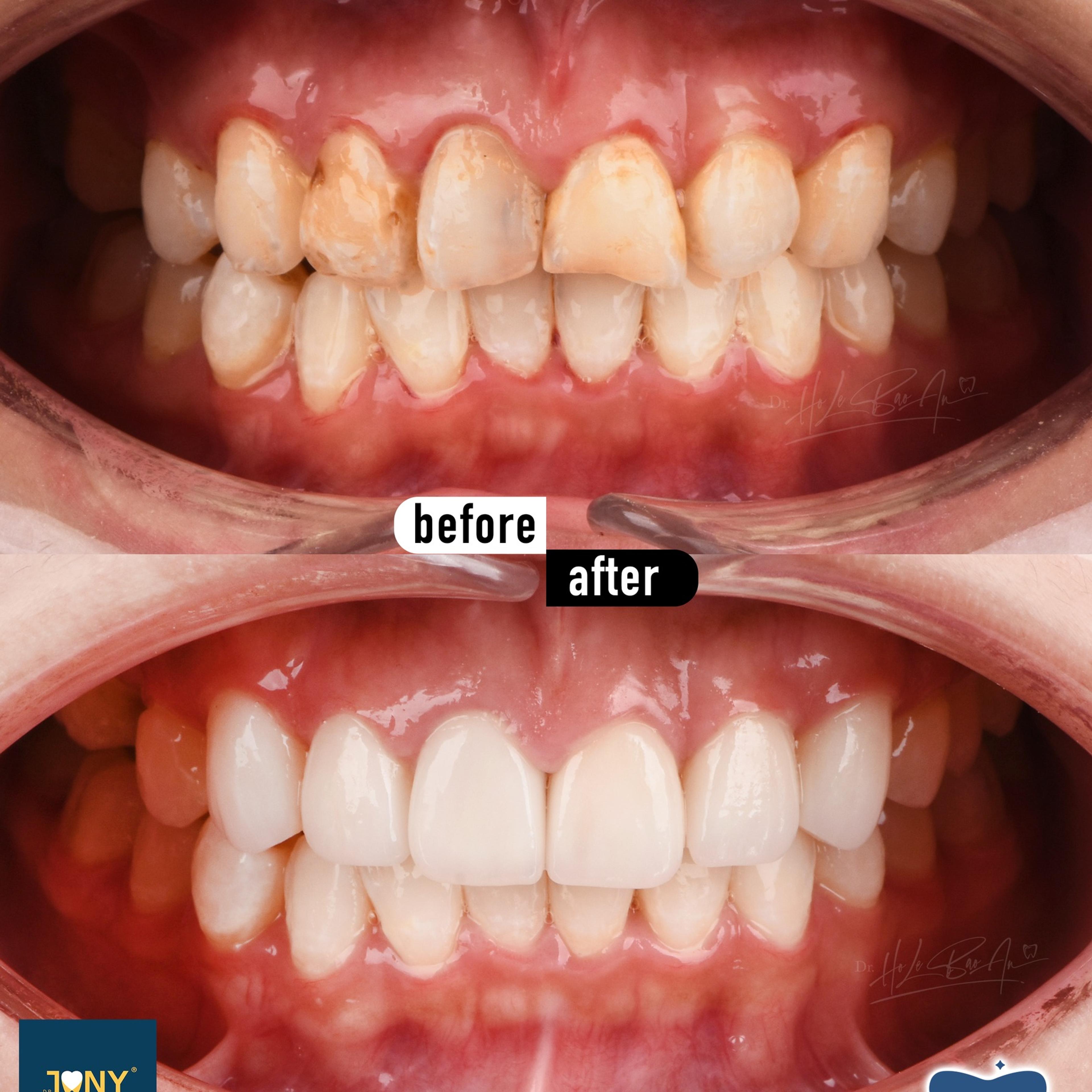 Intraoral views of both arches before and after veneers: patchy discolouration, even in colour and shape afterwards