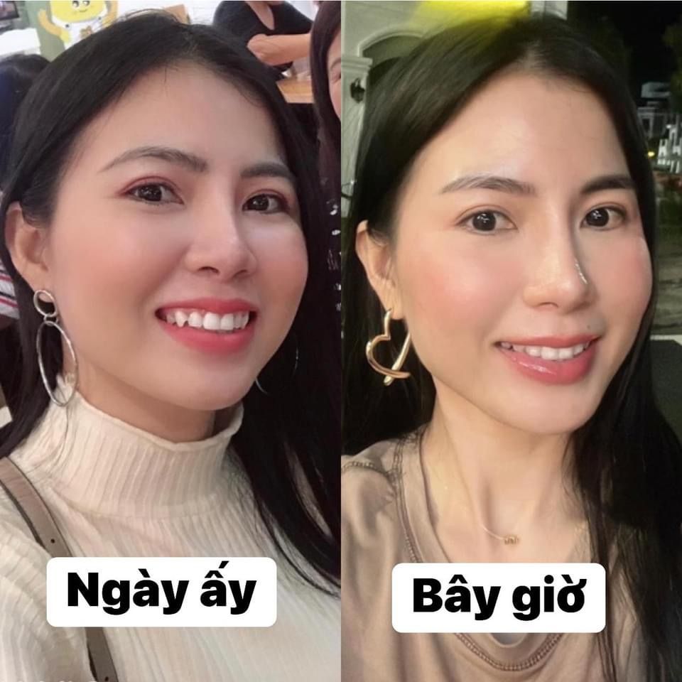 Ảnh bệnh nhân tự chụp, “ngày ấy” và “bây giờ”, sau khi niềng răng trong suốt Invisalign tại Dr Tony Dental