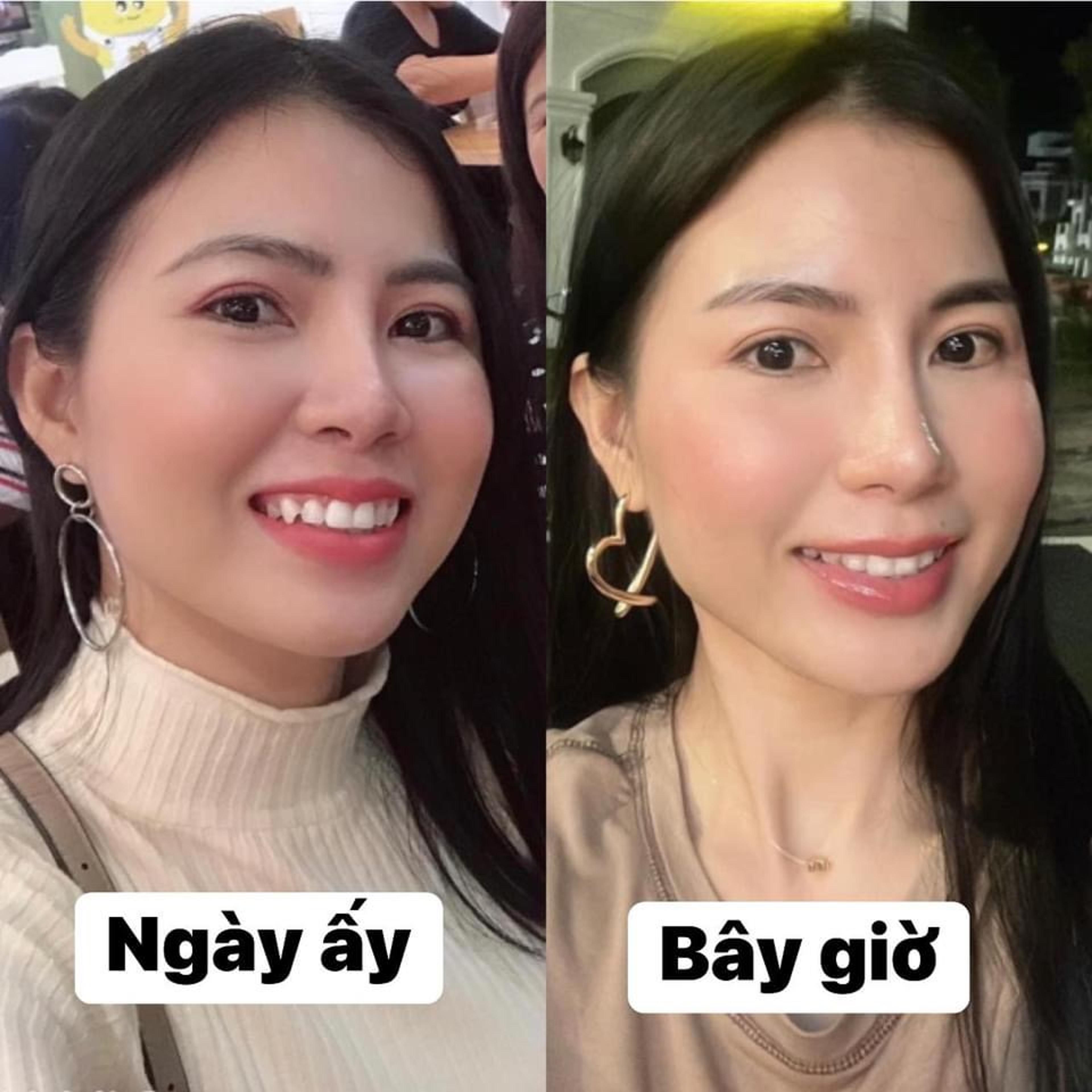 Ảnh bệnh nhân tự chụp, “ngày ấy” và “bây giờ”, sau khi niềng răng trong suốt Invisalign tại Dr Tony Dental
