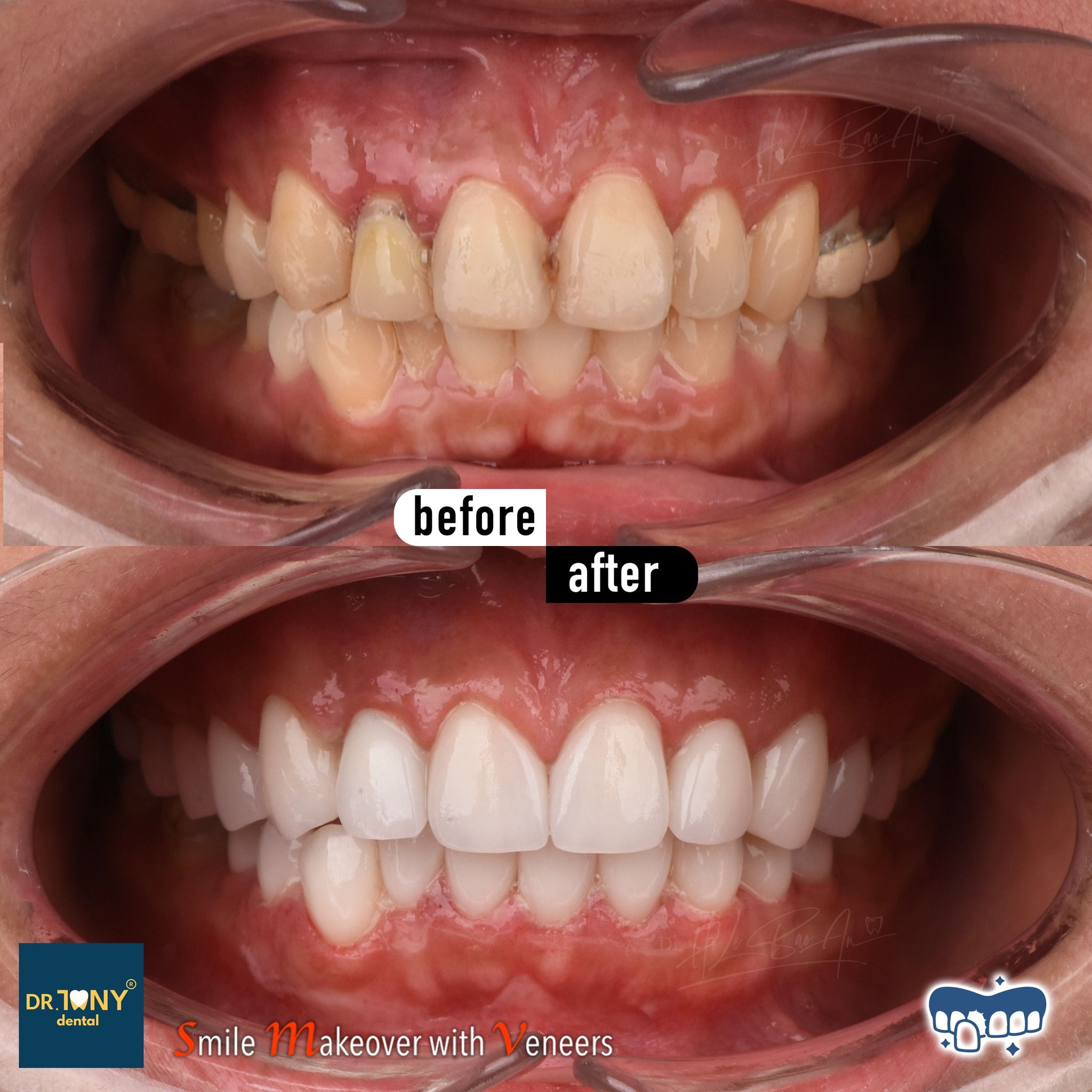 Intraoral views of both arches before and after veneers: yellowed, unevenly coloured teeth, even afterwards