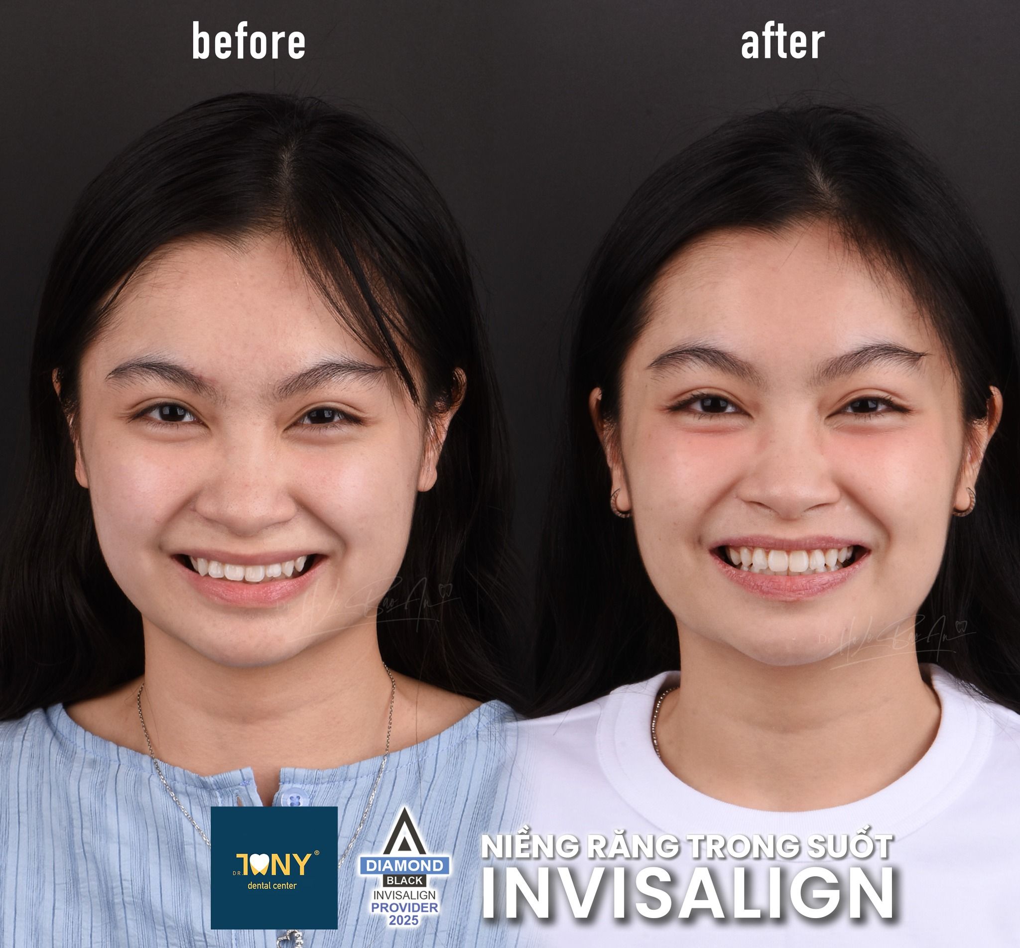 Ca Invisalign gói Comprehensive: khớp cắn ban đầu và sau tinh chỉnh lần 02, kèm khay trong suốt