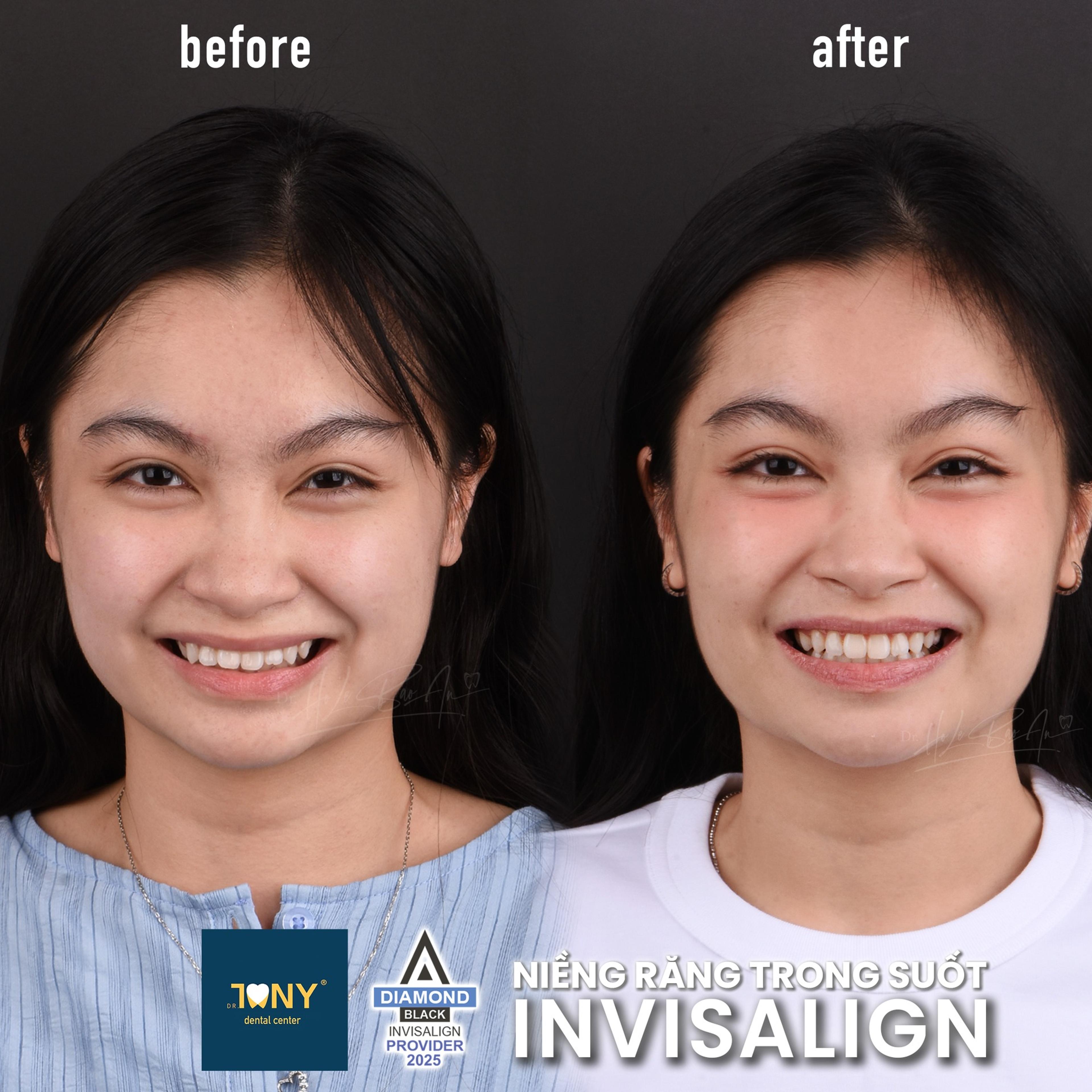 Ca Invisalign gói Comprehensive: khớp cắn ban đầu và sau tinh chỉnh lần 02, kèm khay trong suốt