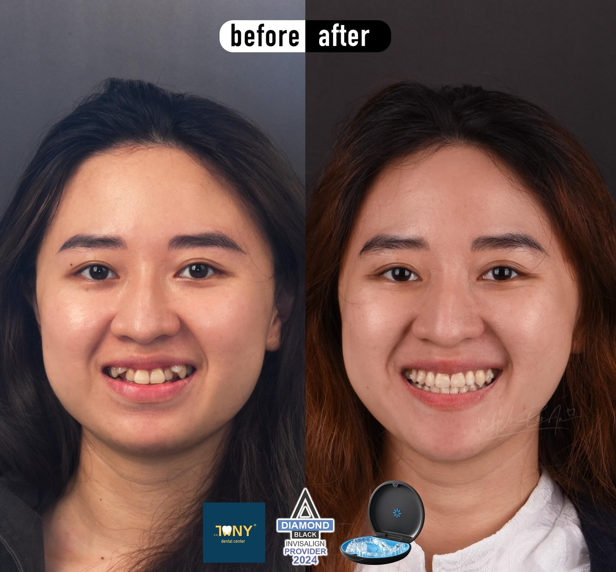 Chân dung trước và sau niềng Invisalign: răng cửa hàm trên chen chúc và xoay, sau điều trị đều và cân đối