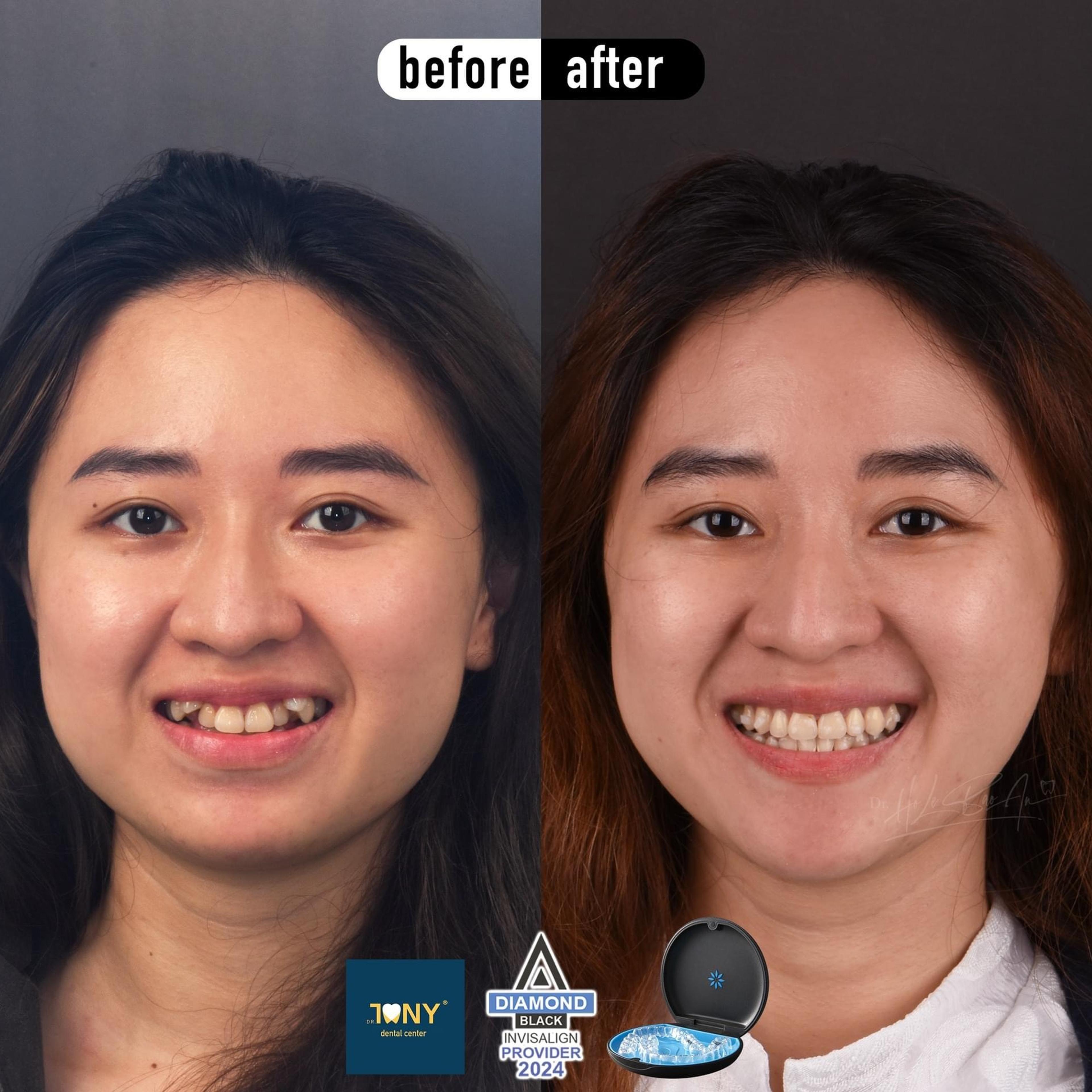Chân dung trước và sau niềng Invisalign: răng cửa hàm trên chen chúc và xoay, sau điều trị đều và cân đối
