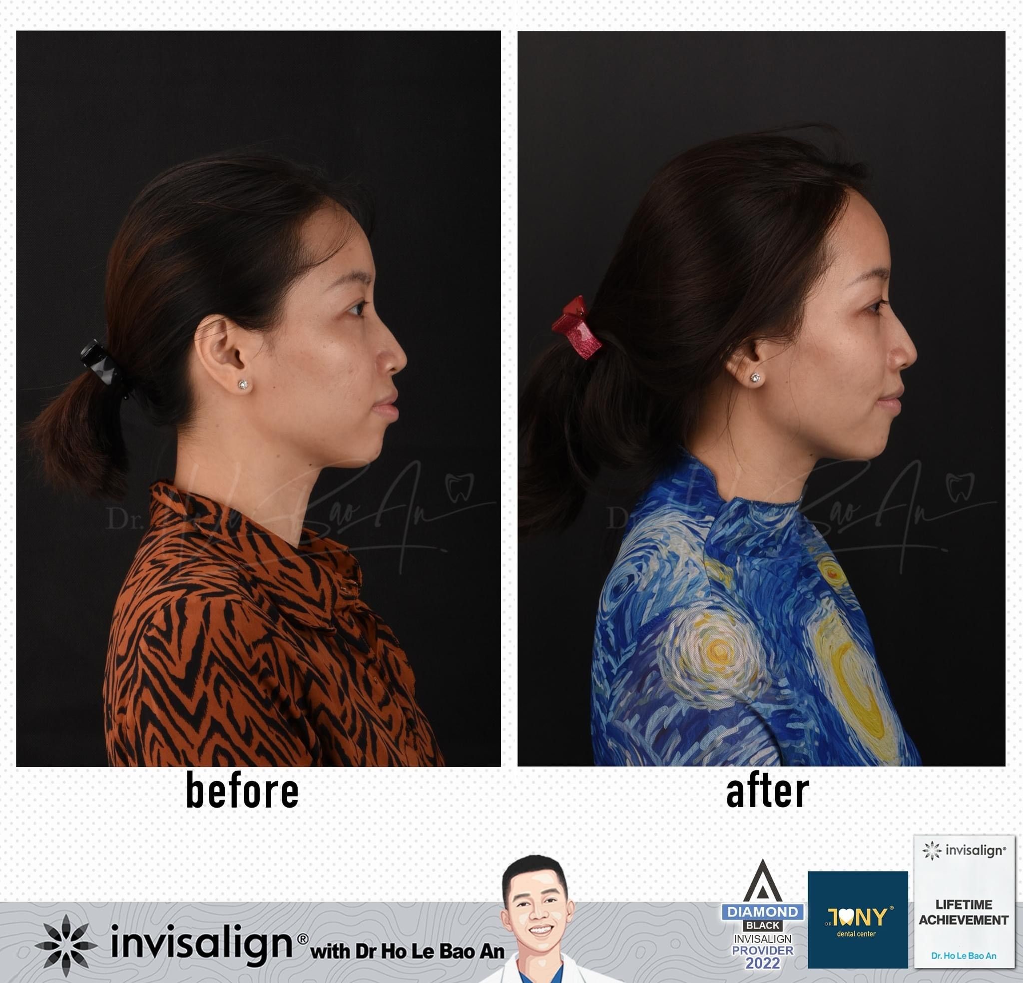 Ảnh nghiêng khuôn mặt trước và sau niềng răng trong suốt Invisalign: môi và cằm cân đối hơn sau điều trị