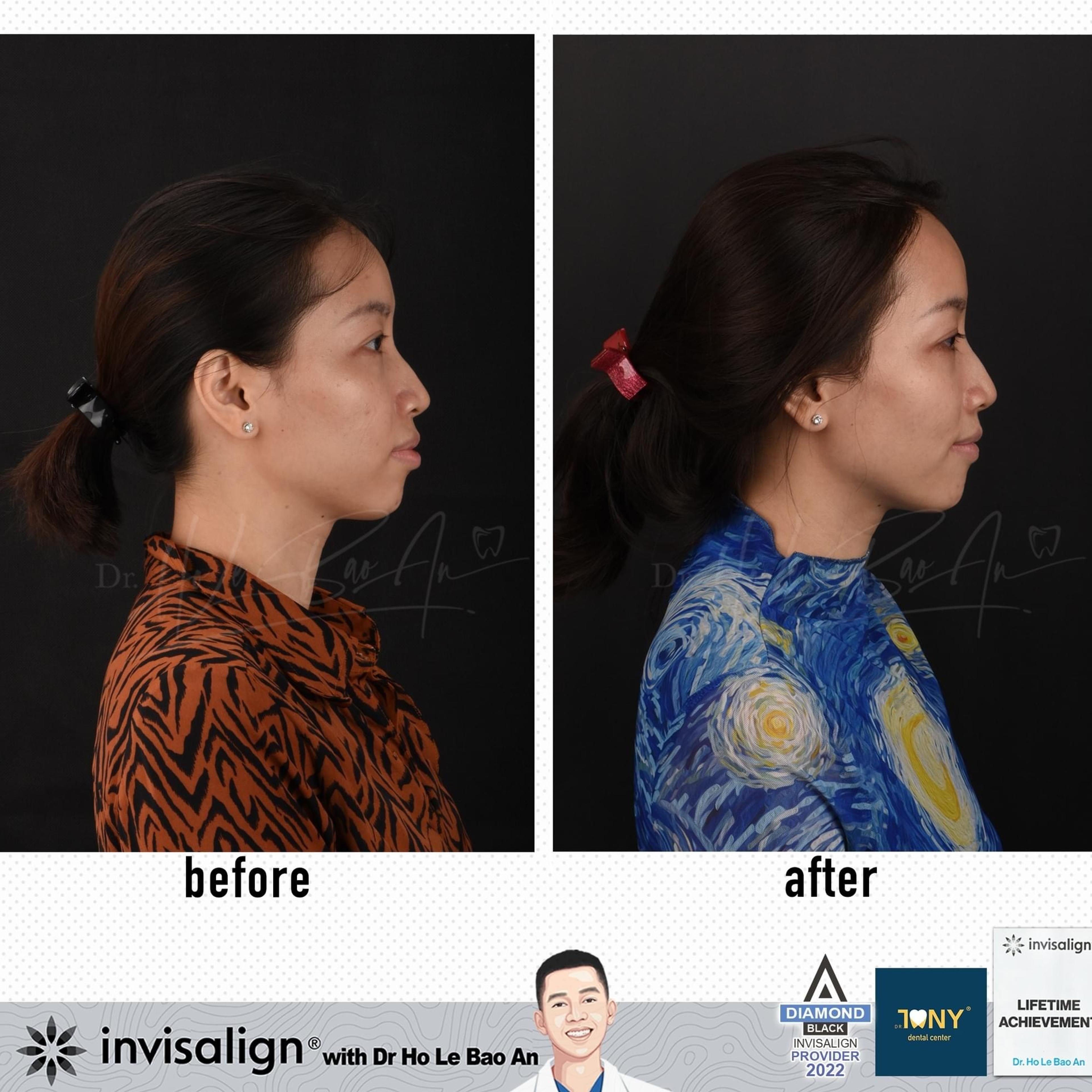 Ảnh nghiêng khuôn mặt trước và sau niềng răng trong suốt Invisalign: môi và cằm cân đối hơn sau điều trị