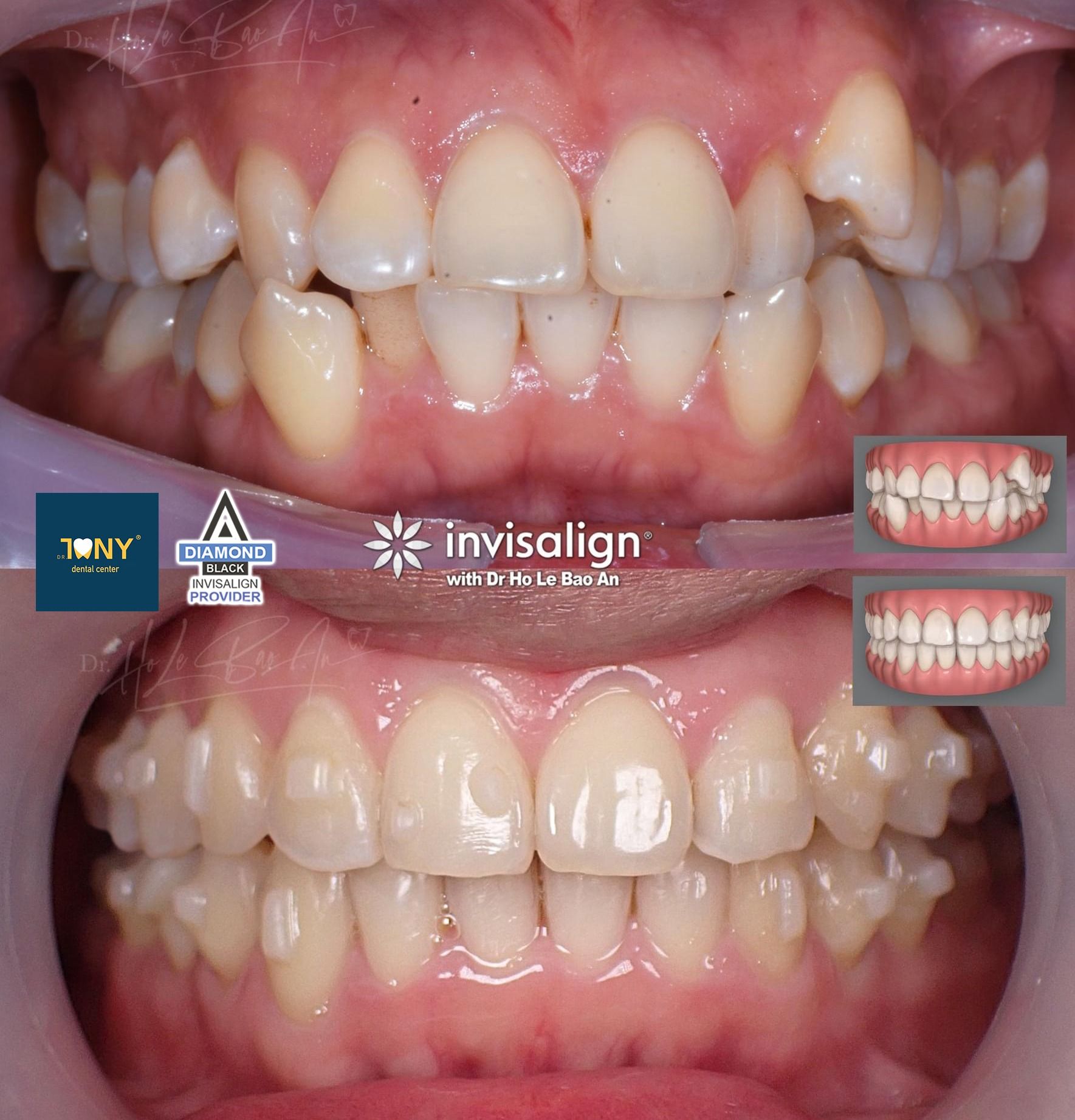Ảnh trong miệng trước và sau niềng Invisalign: răng chen chúc, răng nanh hàm trên mọc chìa, sau điều trị hai hàm đều