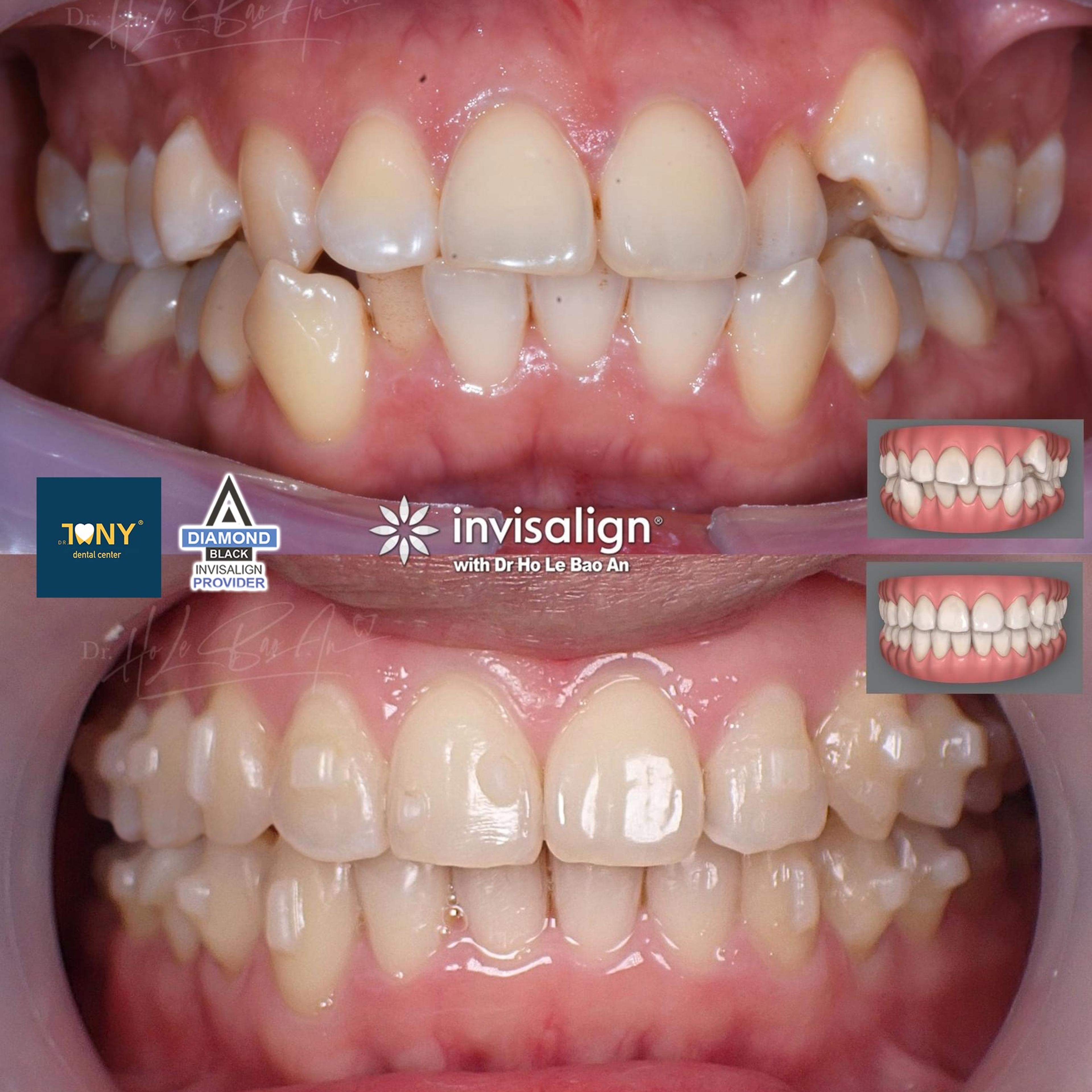 Ảnh trong miệng trước và sau niềng Invisalign: răng chen chúc, răng nanh hàm trên mọc chìa, sau điều trị hai hàm đều
