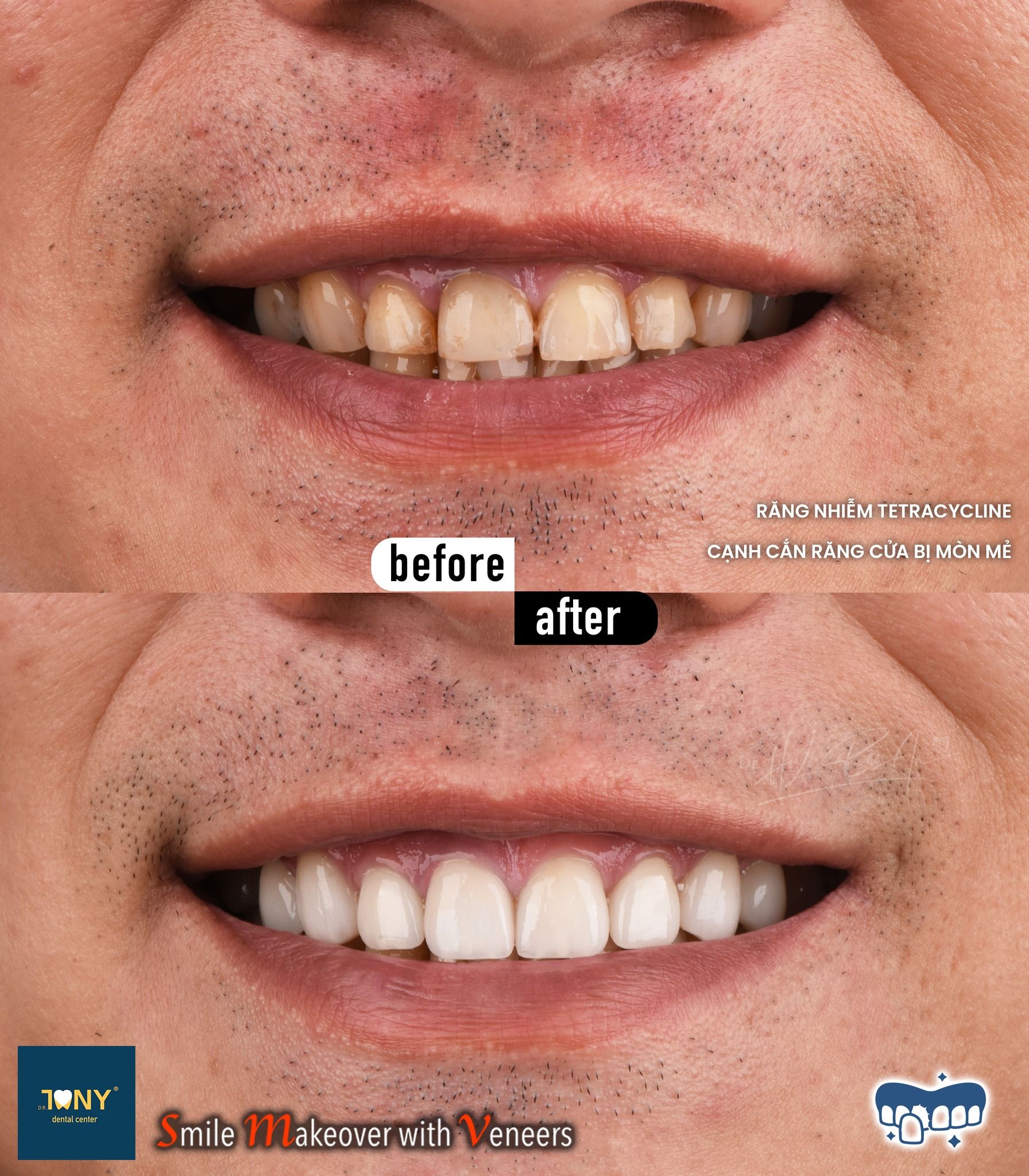 Close-up smile before and after veneers; the photo notes tetracycline staining and worn, chipped incisal edges
