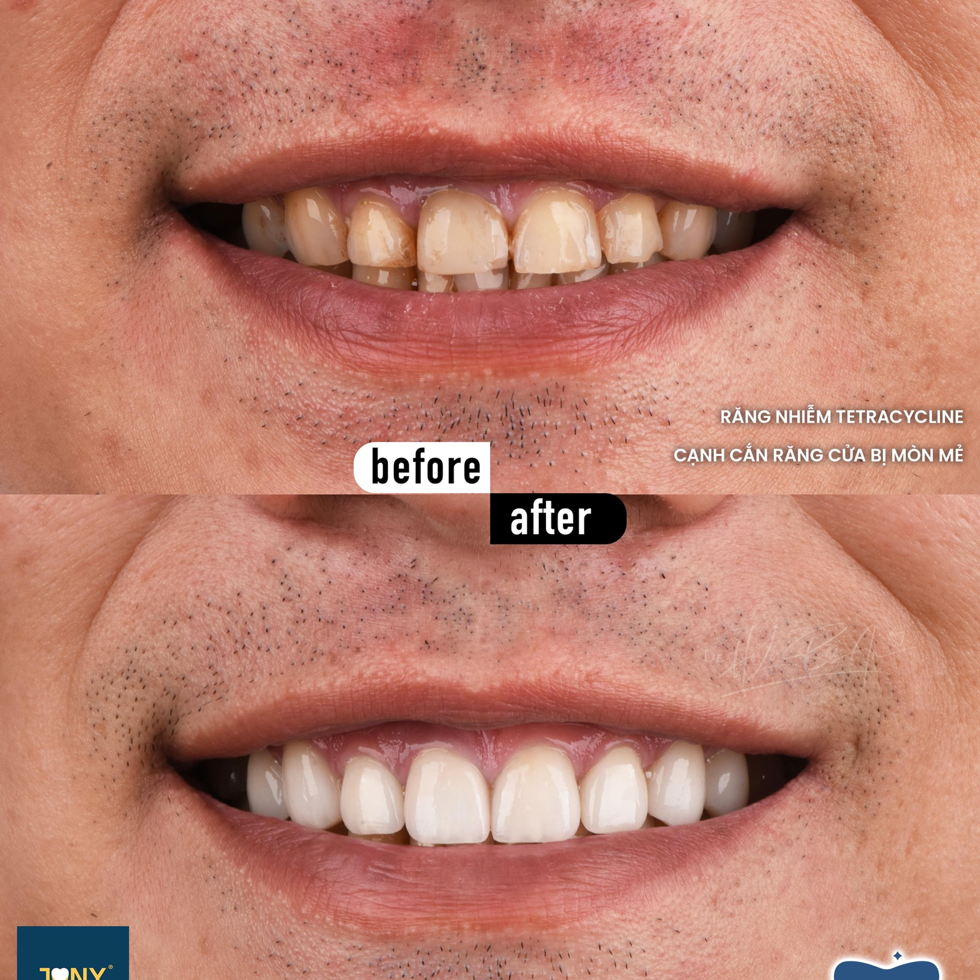 Close-up smile before and after veneers; the photo notes tetracycline staining and worn, chipped incisal edges