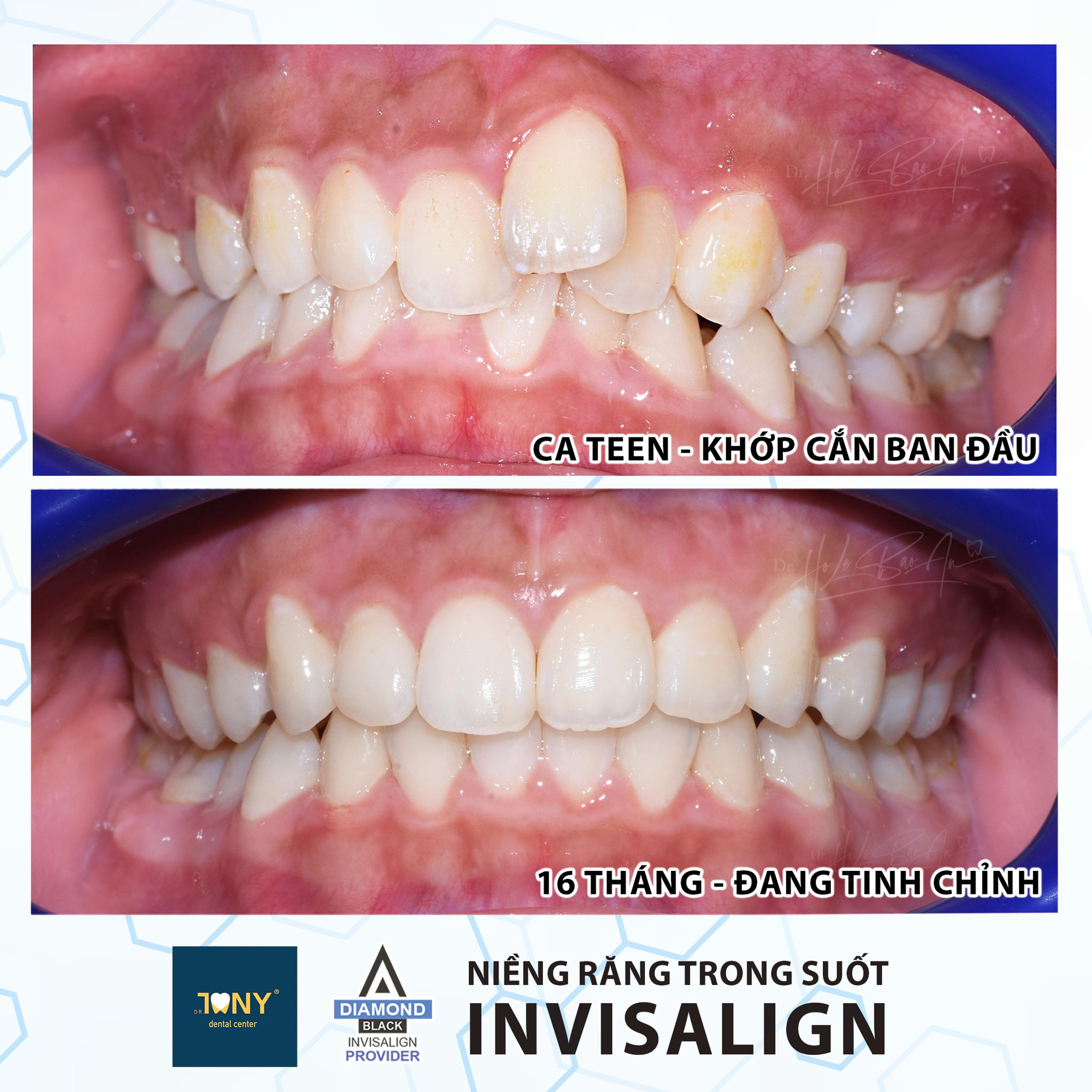 Ca Invisalign tuổi teen: khớp cắn ban đầu có răng nanh mọc lệch cao, và ảnh sau 16 tháng đang tinh chỉnh