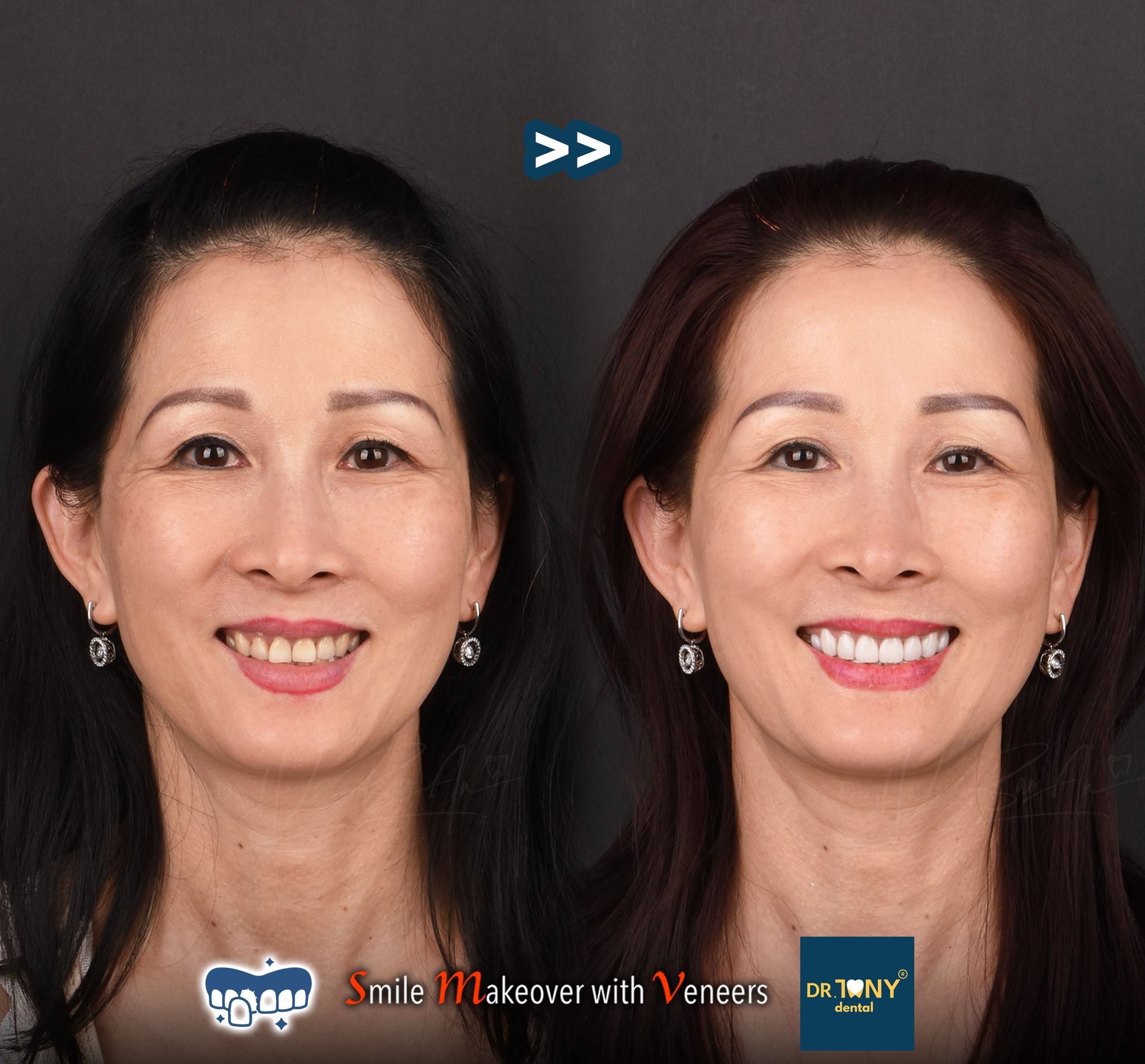 Full-face smile before and after porcelain veneers: discoloured, unevenly worn incisors, even afterwards