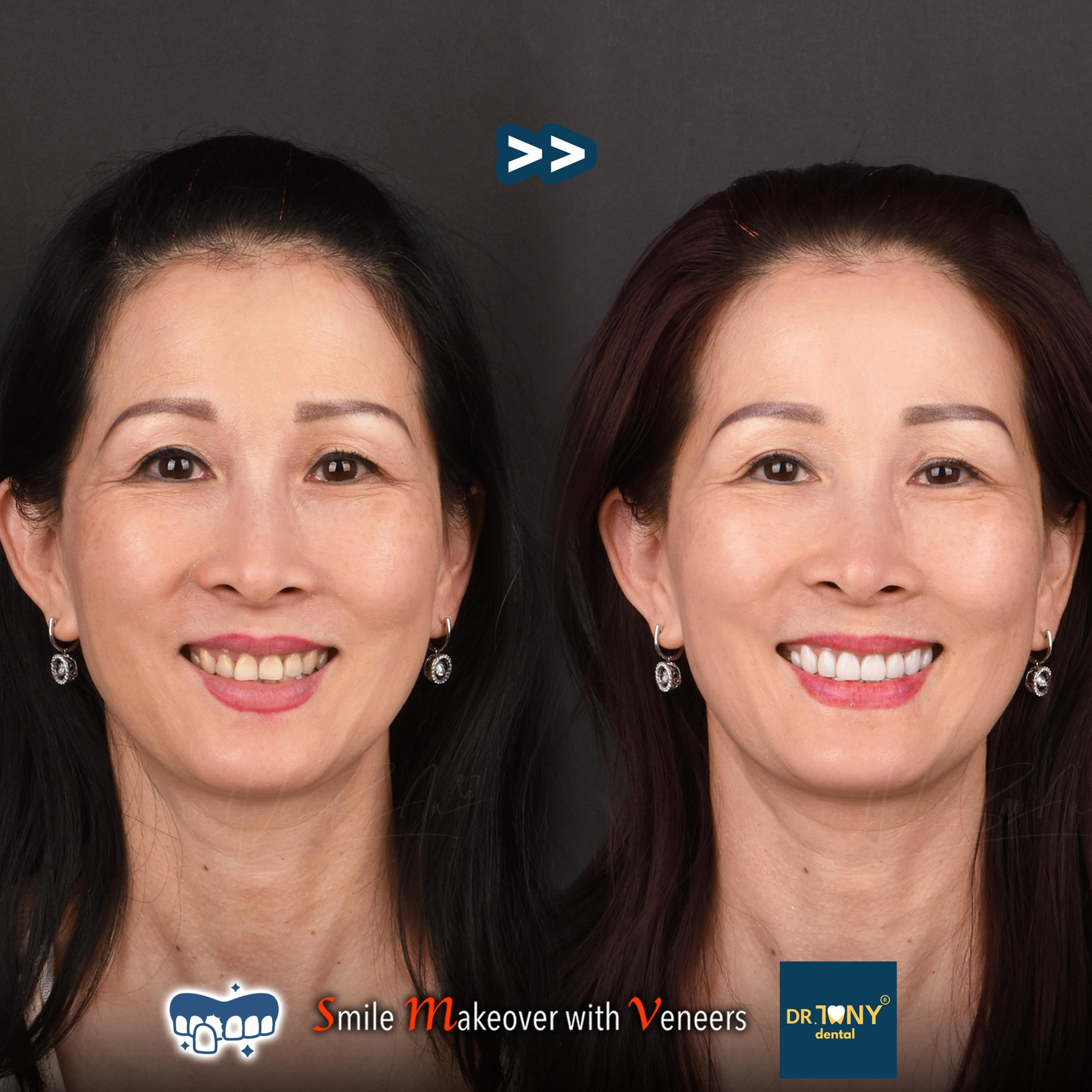 Full-face smile before and after porcelain veneers: discoloured, unevenly worn incisors, even afterwards