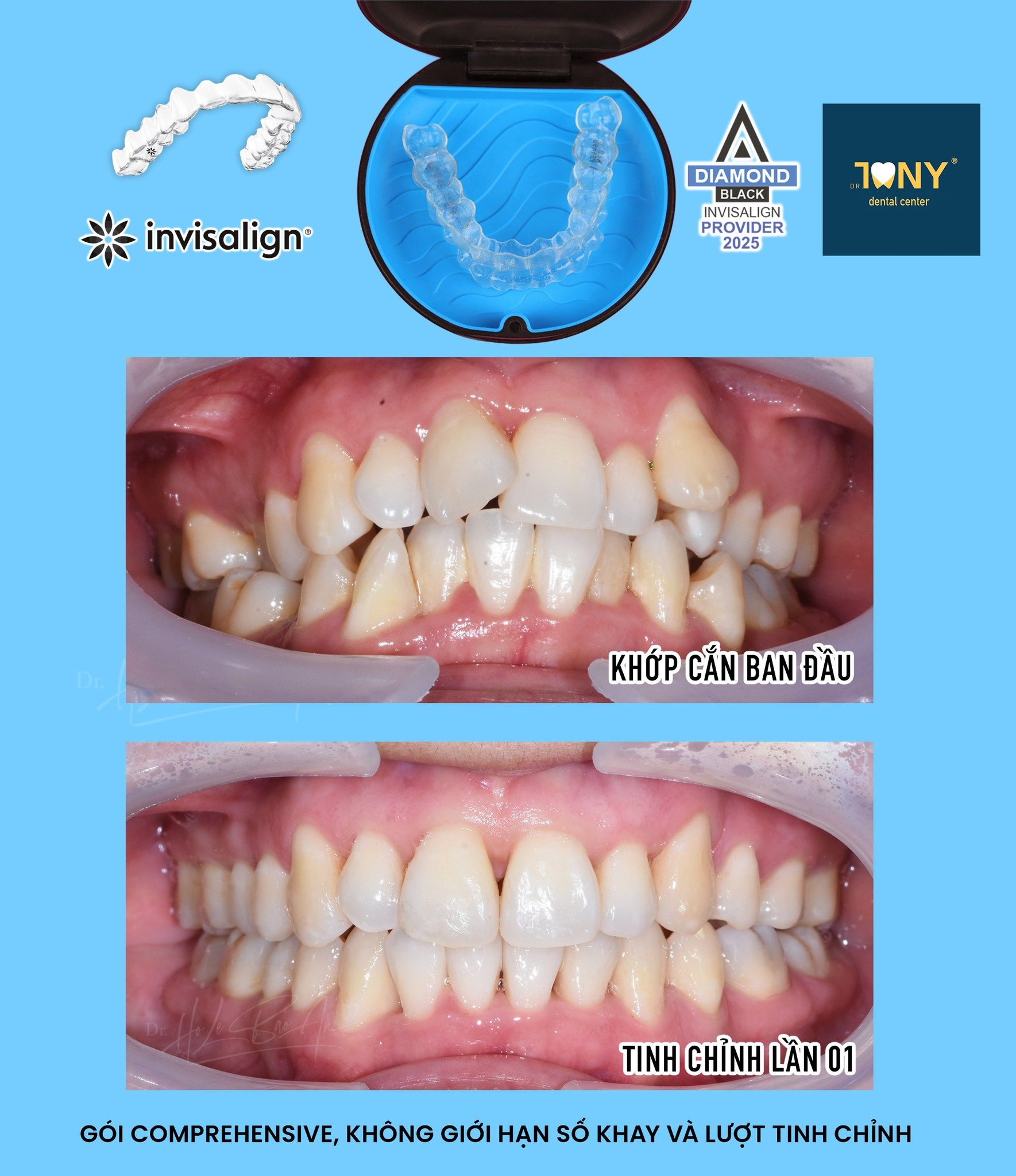 Khay Invisalign và hộp đựng, kèm ảnh khớp cắn ban đầu và sau tinh chỉnh lần 01 của gói Comprehensive