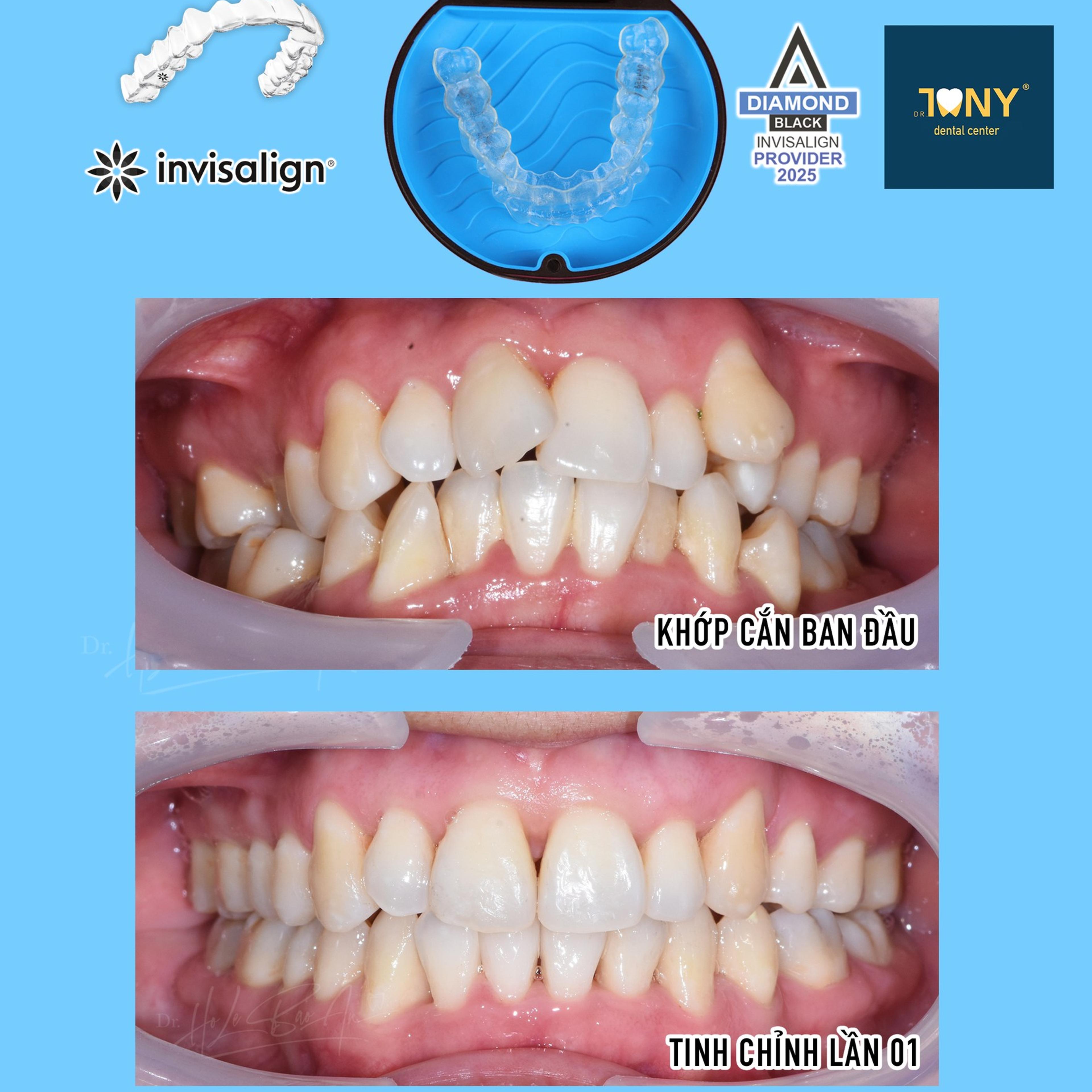 Khay Invisalign và hộp đựng, kèm ảnh khớp cắn ban đầu và sau tinh chỉnh lần 01 của gói Comprehensive