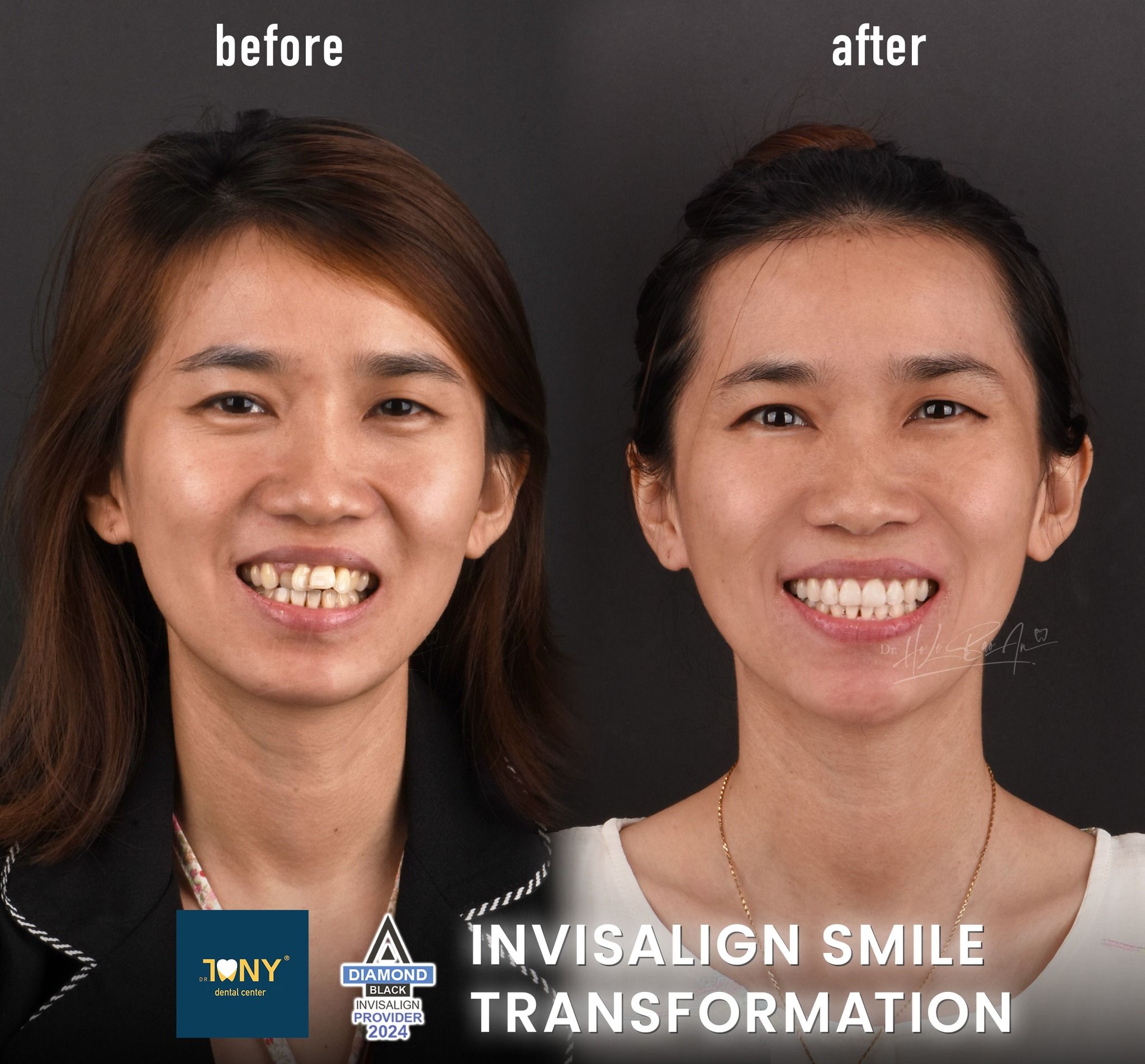 Chân dung trước và sau niềng răng trong suốt Invisalign — răng cửa hết chen chúc, nụ cười đều hơn