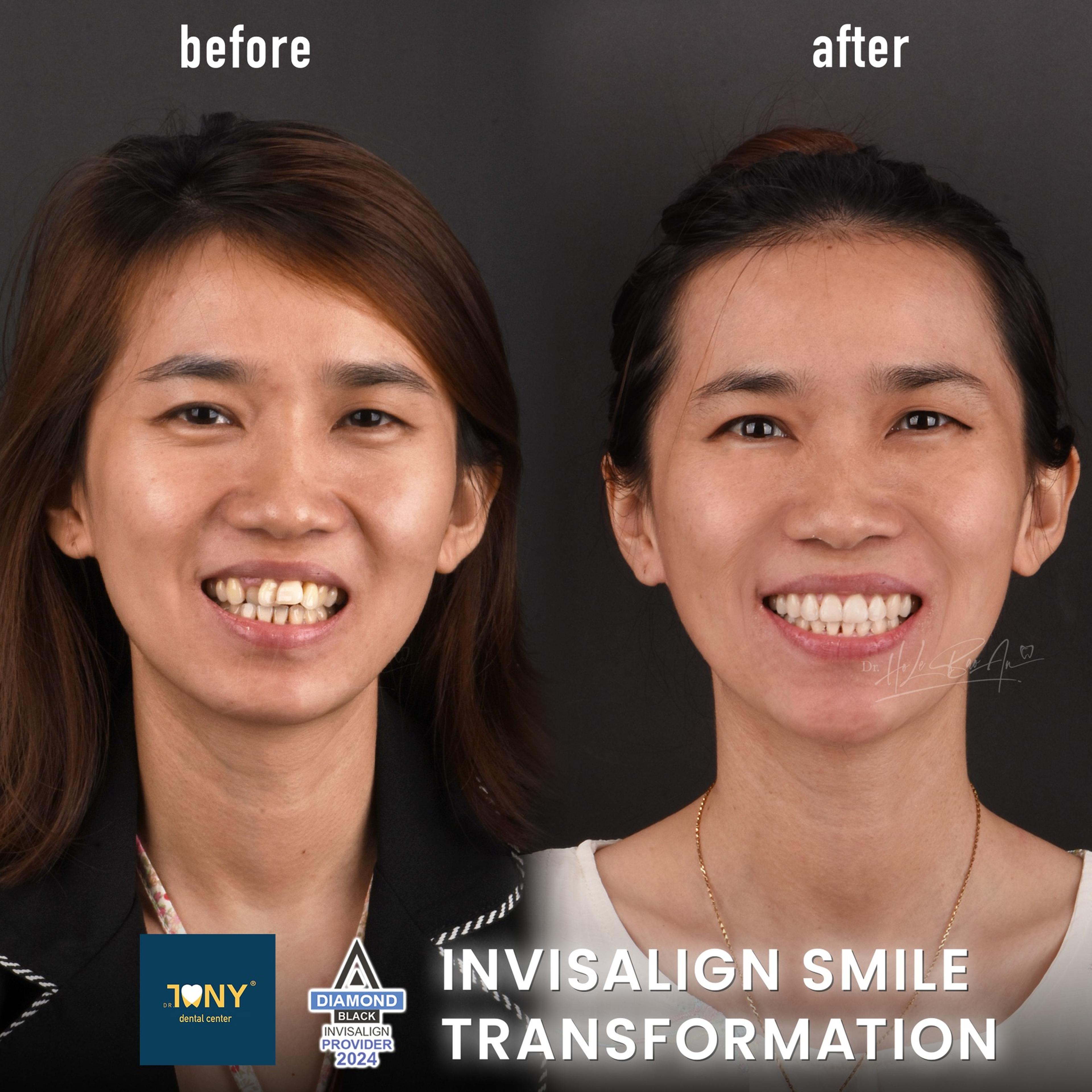 Chân dung trước và sau niềng răng trong suốt Invisalign — răng cửa hết chen chúc, nụ cười đều hơn