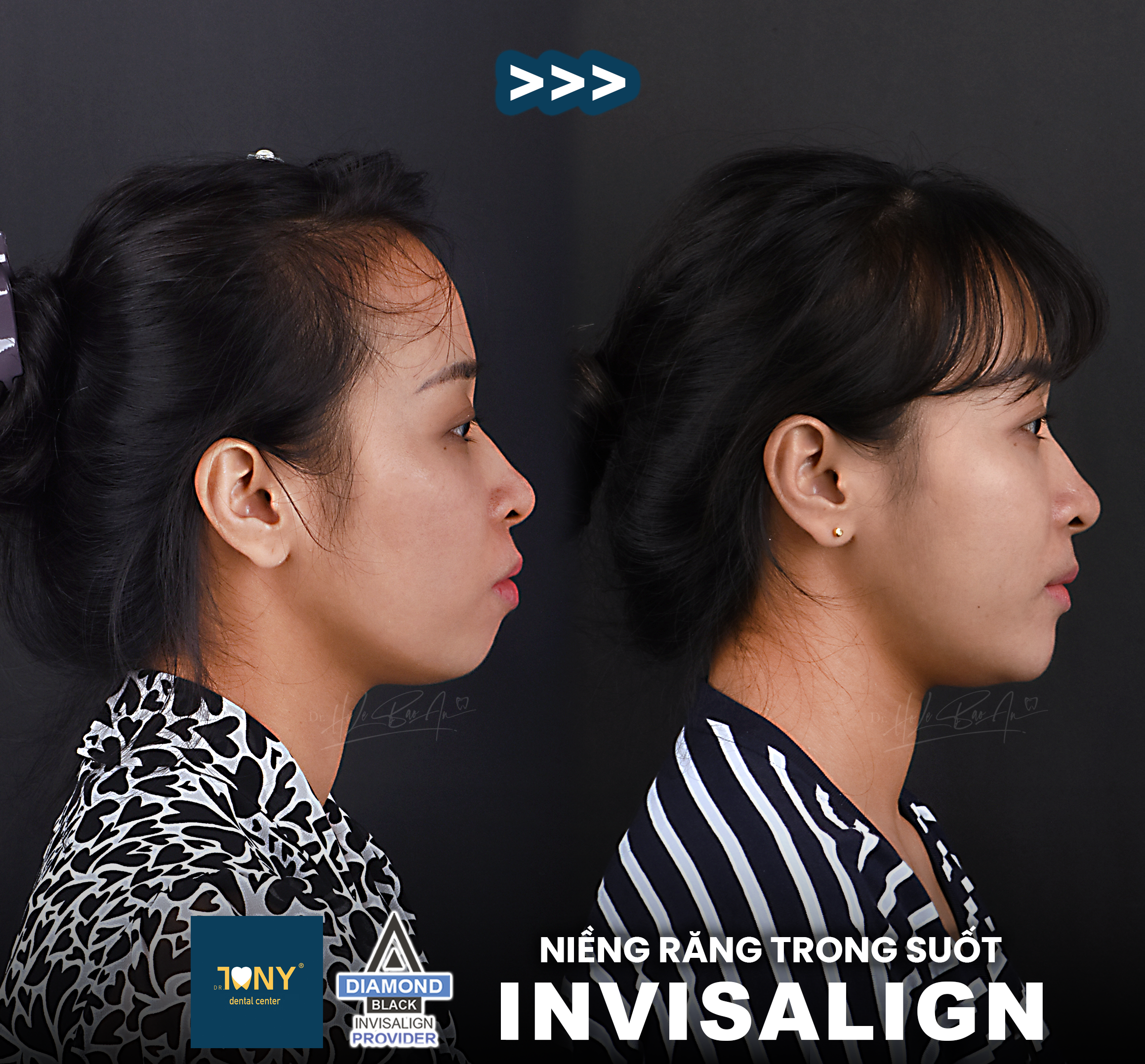 Invisalign
