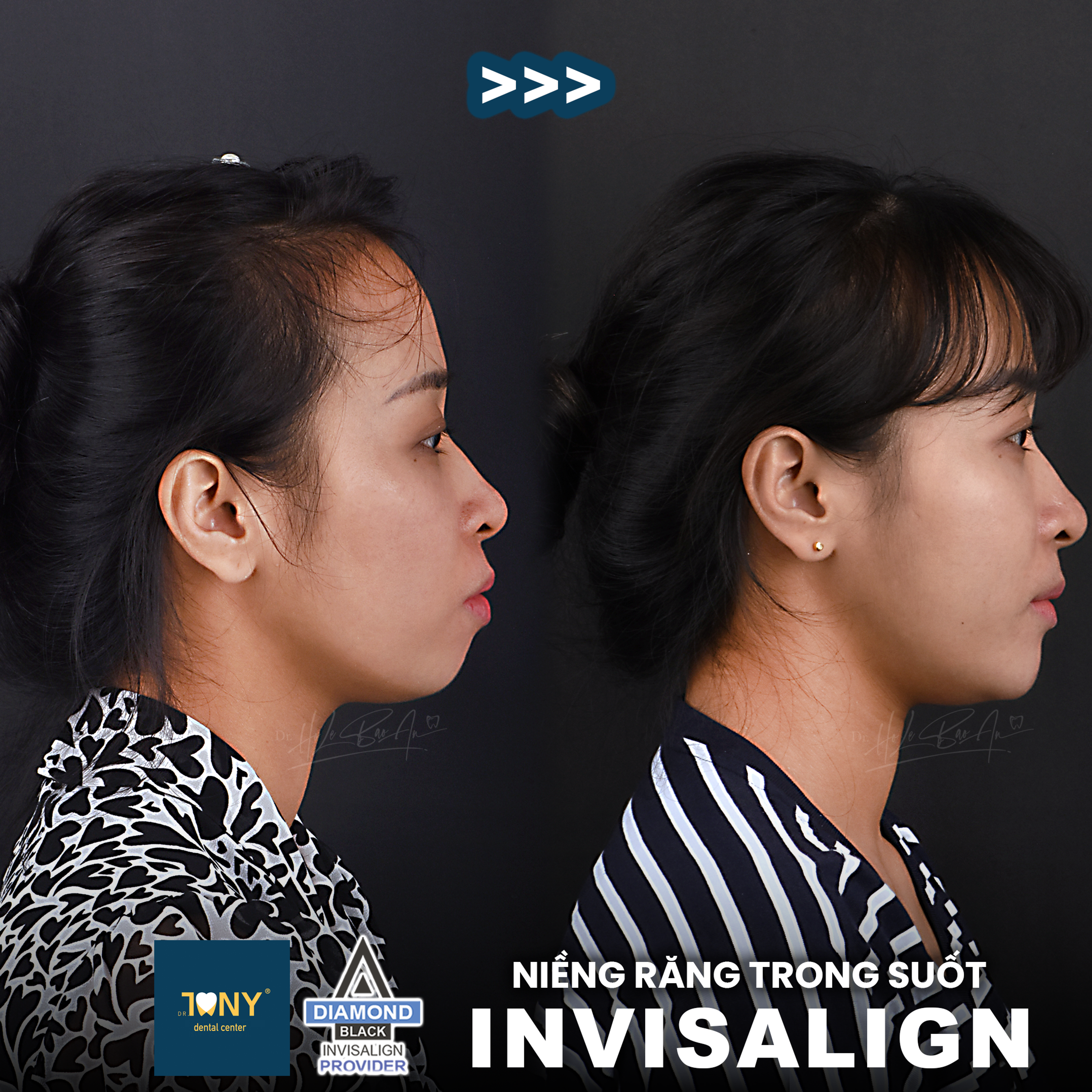 Invisalign