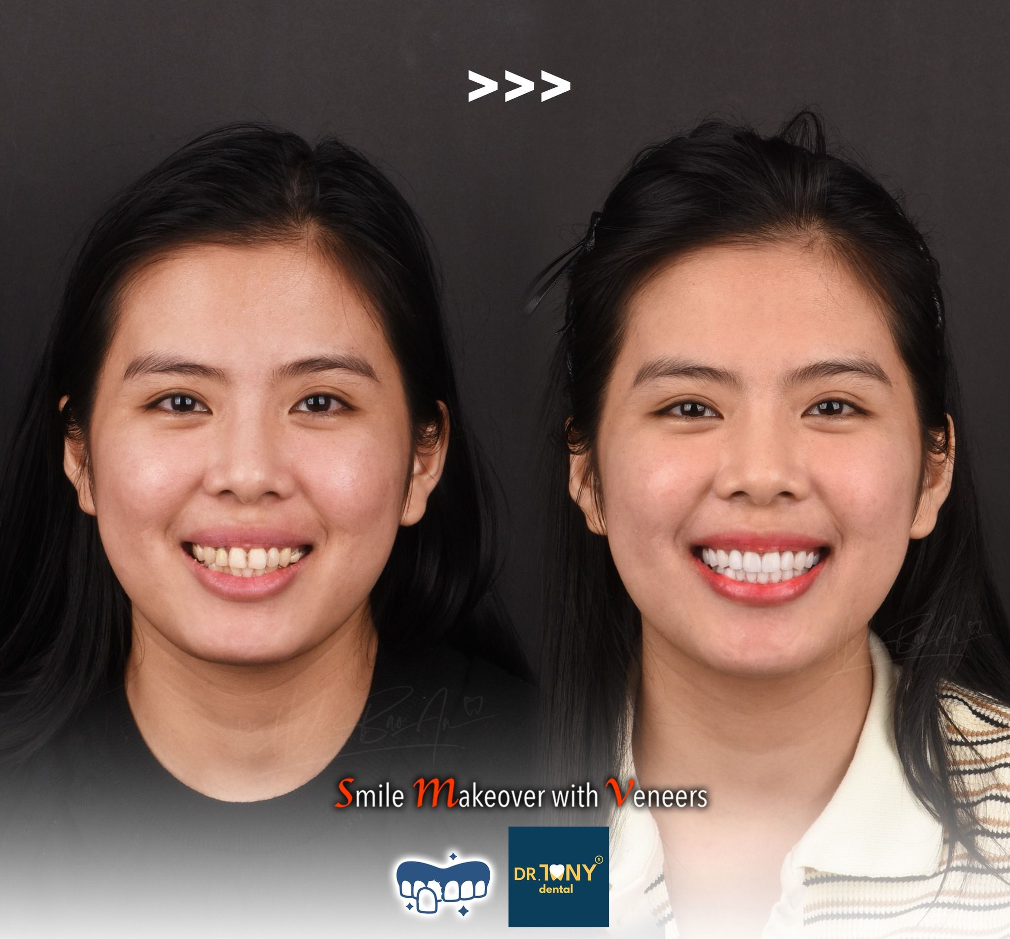 Full-face smile before and after porcelain veneers: misaligned, discoloured incisors, even and bright afterwards