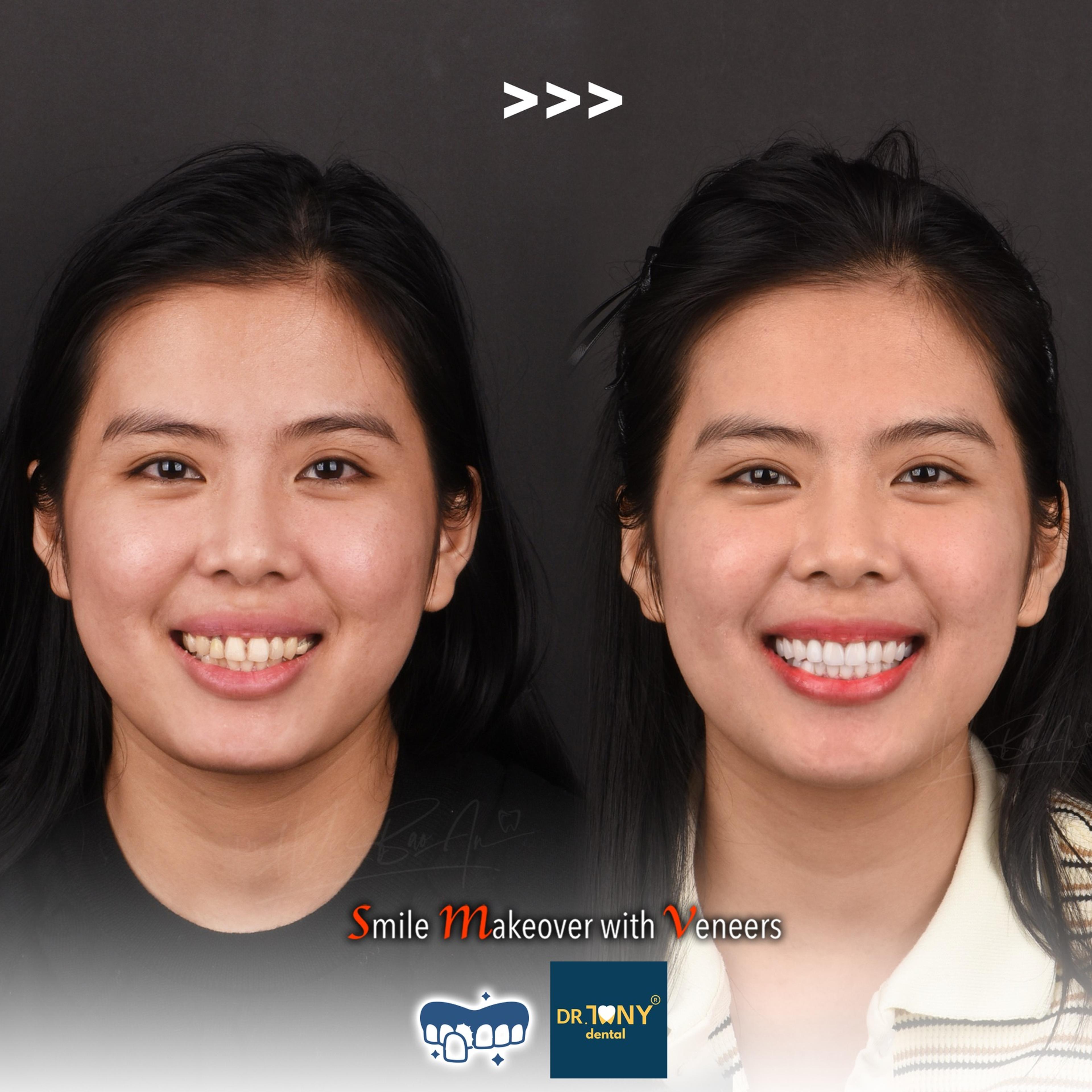 Full-face smile before and after porcelain veneers: misaligned, discoloured incisors, even and bright afterwards
