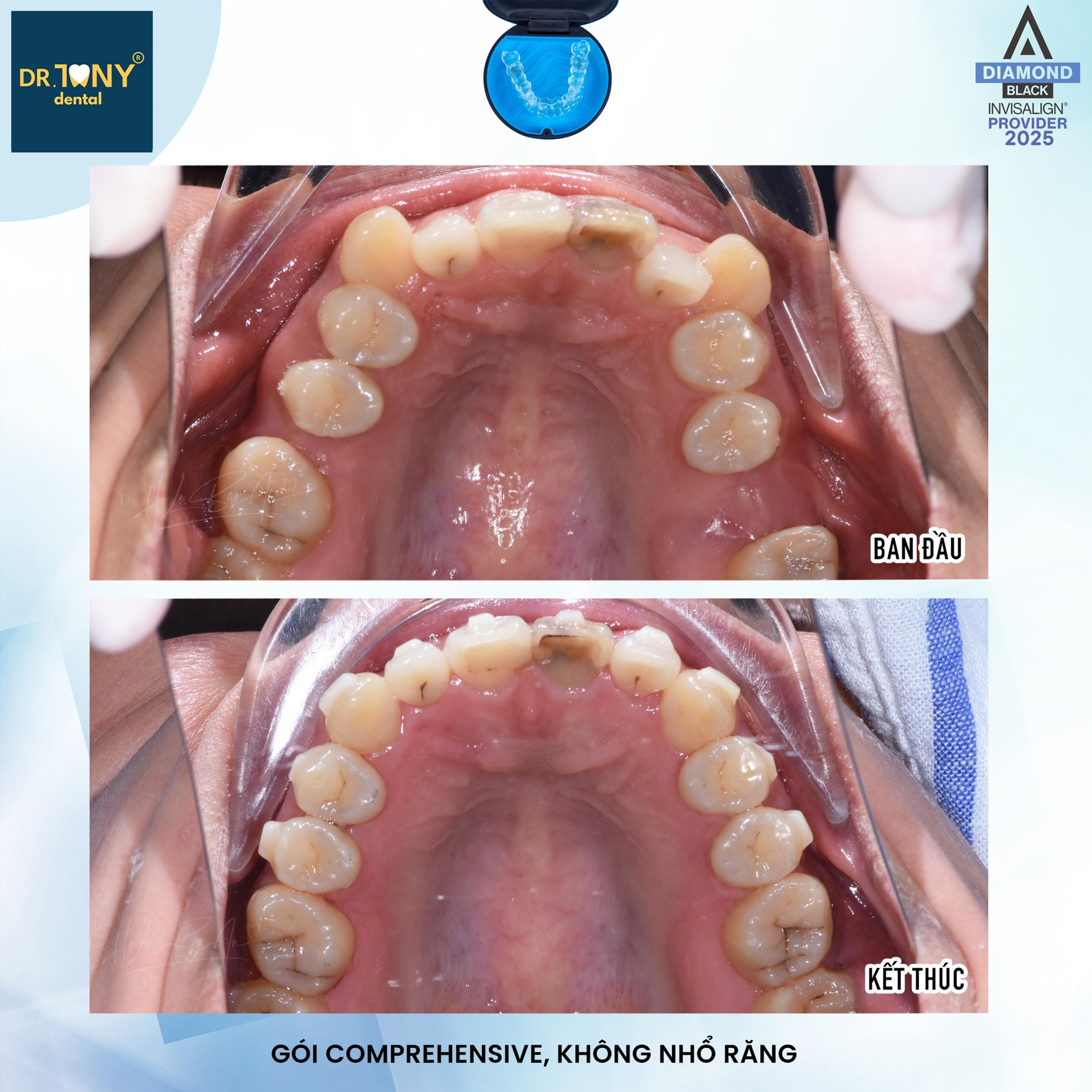 Ảnh mặt nhai hàm trên, ban đầu và kết thúc — ca Invisalign Comprehensive điều trị không nhổ răng